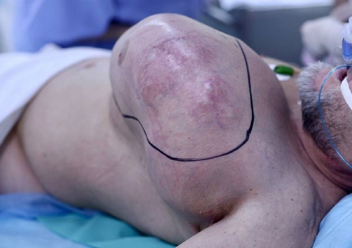 Гигантскую опухоль удалили пациенту врачи в Обнинске   kaluganews ru fn 1781365 html В Медицинском радиологическом научном центре МРНЦ имени А Ф Цыба в Обнинске проведена уникальная операция Хирурги удалили гигантскую рецидивную опухоль грудной клетки   Прислать новость Подписаться