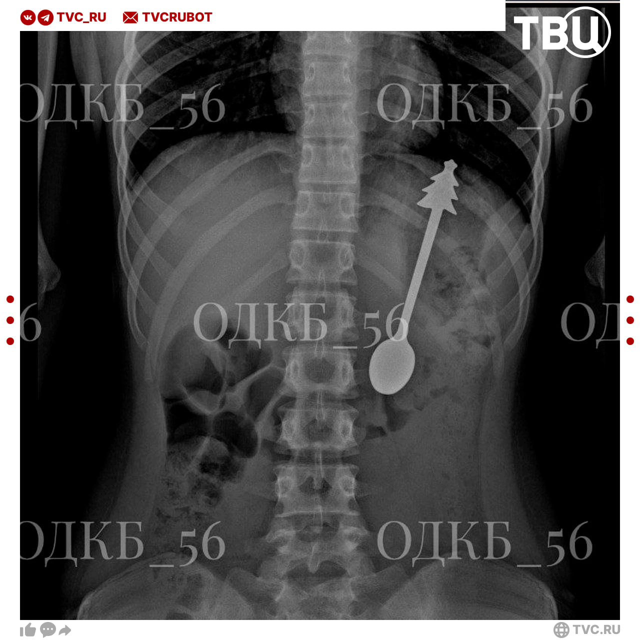 Ребенок проглотил ложку длиной 14 сантиметров в Оренбурге Врачи областной клинической больницы провели обследование После чего они перевели ребенка в реанимацию и без разрезов удалили ложку из желудка После операции ребенок хорошо себя чувствовал его отправили домой на следующий день Подписаться на ТВЦ в MAX Ставьте   профессионализму