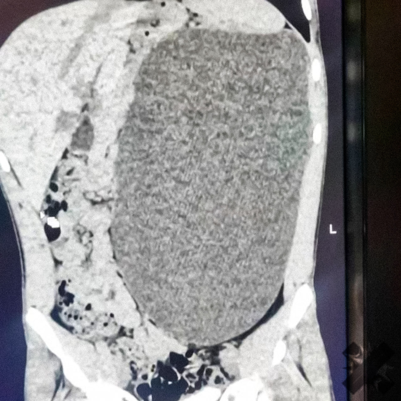 Почка размером с пятилитровую бутылку выросла у подростка Образование заняло почти весь живот и сдавливало внутренние органы При этом 17 летний парень из Новосибирска не чувствовал никаких симптомов и считал себя абсолютно здоровым Любой сильный удар в живот мог закончиться очень плохо Четыре дня врачи откачивали жидкость а затем удалили поражённую почку сейчас подросток идёт на поправку НМШ