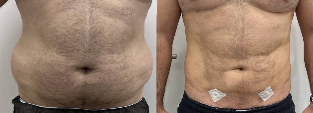 Российские мужчины стали массово делать пластические операции Самые популярные процедуры подтяжка лица рельеф мышц липосакция и подтяжка ягодиц