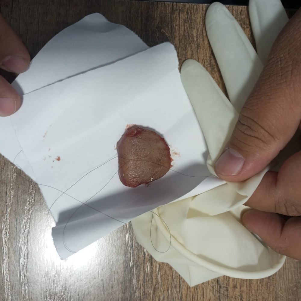 В Манасе девушка откусила язык парню во время поцелуя С уулу Н 1999 года рождения встречался с девушкой по имени А Ж 2006 года рождения 8 ноября они вместе присутствовали на свадьбе где употребляли спиртные напитки Во время поцелуя А Ж укусила молодого человека повредив нижнюю губу и язык В УВД сообщили что оба участника инцидента находятся в здравом уме и не состоят на учете у психиатра Директор Джалал Абадской областной клинической больницы Кумар Ботокараев подтвердил редакции данный случай У парня откушены кончик языка и часть нижней губы Пациенту провели операцию зашили поврежденные участки Сейчас он находится в отделении челюстно лицевой хирургии и получает лечение Язык может восстановиться Такие травмы обычно случаются при эпилепсии но чтобы во время поцелуя такое в моей практике впервые сообщил Ботокараев