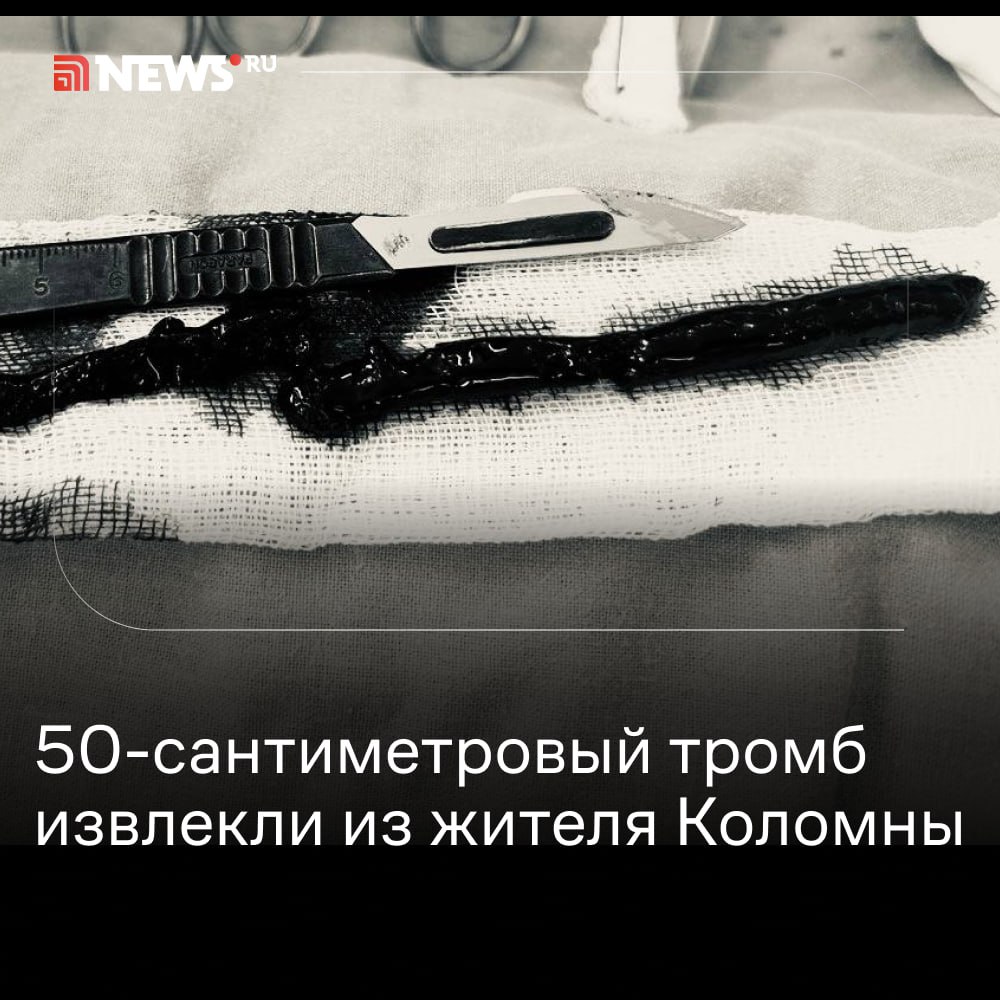 Огромный тромб вытащили из ноги жителя Коломны.  Тромб у 64-летнего пациента обнаружили врачи коломенской больницы в артерии на уровне бедра и голени, сообщает пресс-служба министерства здравоохранения Московской области. Ему грозила ампутация конечности. Во время операции хирурги с помощью специального катетера по частям вытаскивали тромб.  Длина тромба превысила 50 сантиметров. Врачи смогли восстановить кровоснабжение ноги. Пациент уже ходит и готовится к выписке.