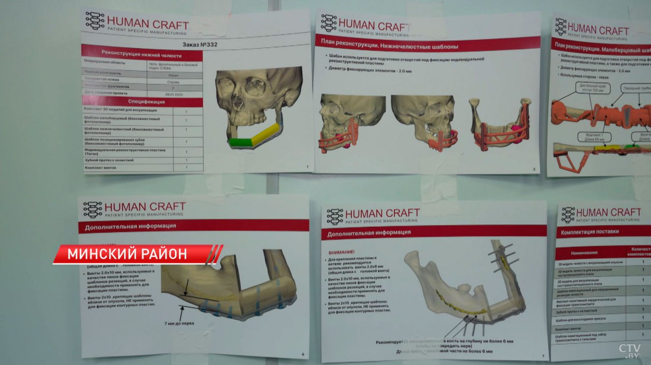 Белорусские врачи провели уникальную операцию по восстановлению челюсти пациента.  В РНПЦ онкологии и медицинской радиологии им. Н. Н. Александрова восстановили нижнюю челюсть пациента из кости голени с использованием 3D-моделирования.   Процесс восстановления включал создание шаблонов и компьютерную томографию. Операция была необходима пациенту, у которого опухоль разрушила часть лицевого скелета. Врачи успешно удалили новообразование и восстановили функции челюсти.  Фото: СТВ  «Минск-Новости» MINSKNEWS.BY Telegram Viber FB VK Inst TikTok  YouTube