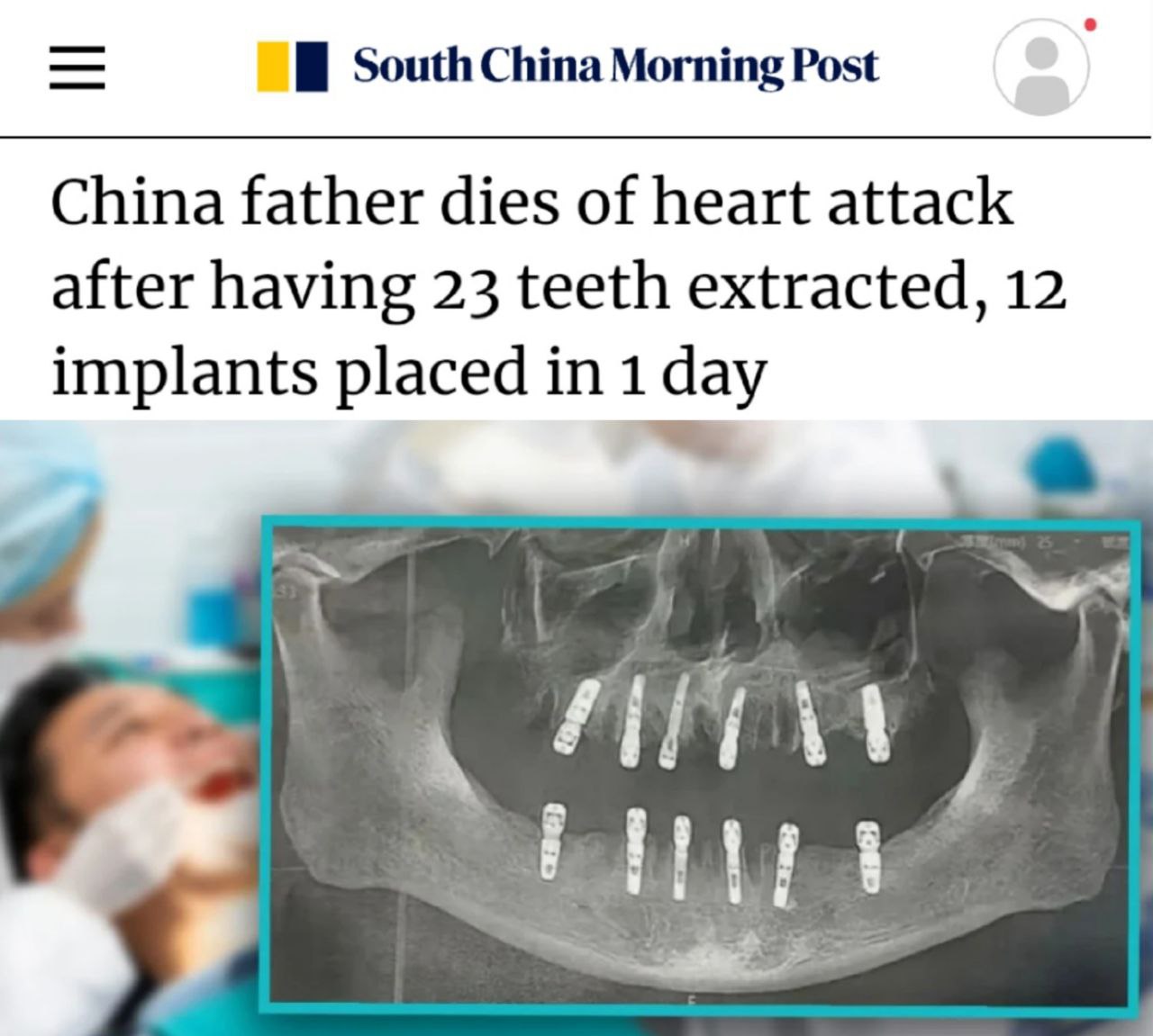 «В Китае мужчина умер от сердечного приступа после того, как ему удалили 23 зуба и установили 12 имплантатов в один день»: Экспресс-стоматология с сильным побочным эффектом.  «По словам дочери покойного, хирург использовал метод «немедленной реставрации» зубов. Мужчина после врачебного вмешательства начал жаловаться на нестерпимую боль, и через 13 дней умер от внезапной остановки сердца.  Представитель медучреждения, в котором сделали злополучную операцию, отметил, что обычно за один раз удаляют не более 10 зубов. Он добавил, что не понимает, почему в данном случае медик решился на такую серьезную операцию: «Удаление 23 зубов — это очень много. Для проведения такой процедуры стоматолог должен обладать достаточной квалификацией и опытом. Также важно учитывать физические возможности пациента — не каждый может справиться с такой обширной процедурой»
