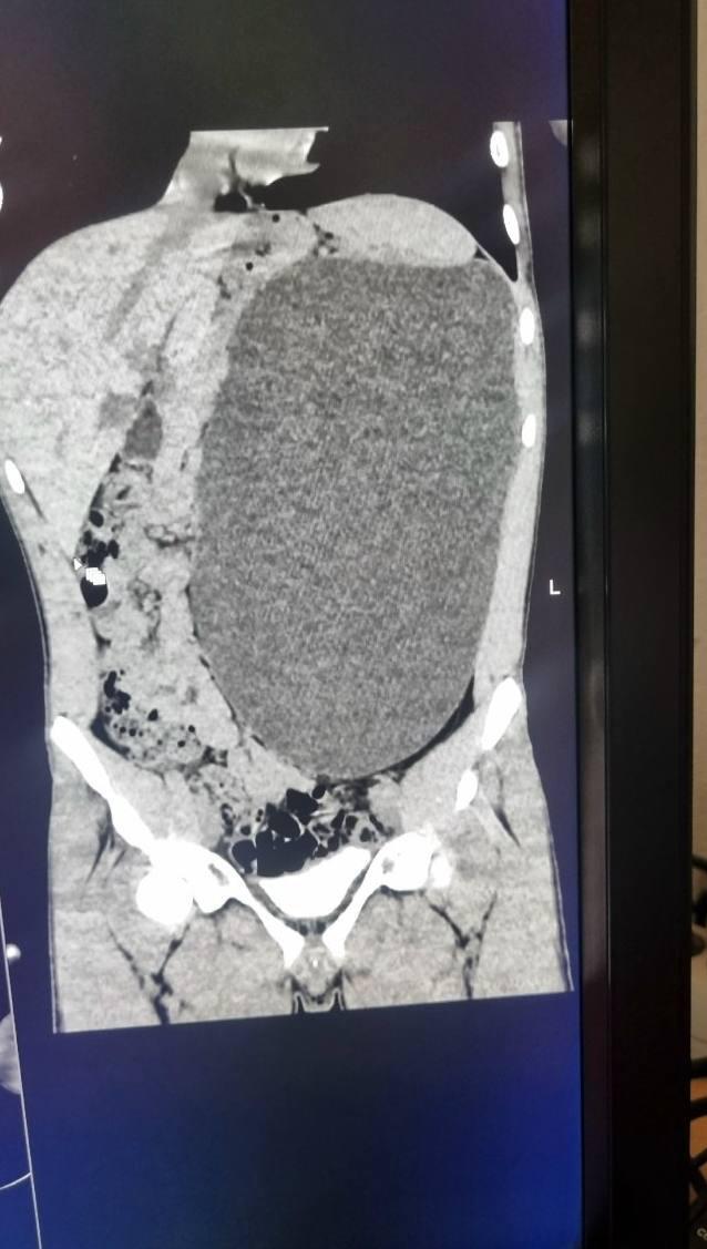 В Новосибирске у подростка удалили почку размером с пятилитровую бутылку Как отметили в больнице это была настоящая бомба замедленного действия случайный удар в живот и мешок мог разорваться До обследования подросток не испытывал никаких симптомов и считал себя полностью здоровым Фото Telegram канал Министерства здравоохранения Новосибирской области