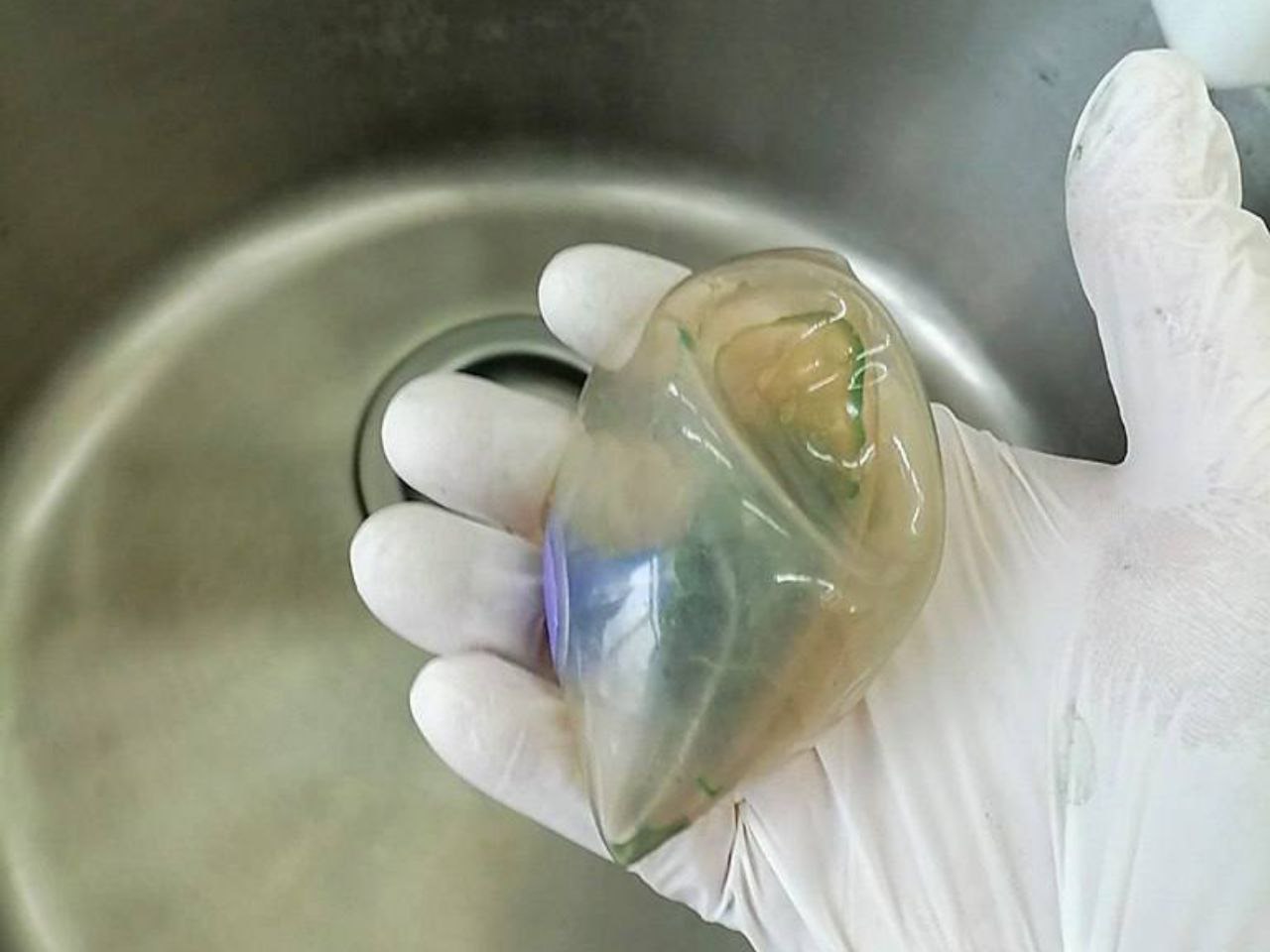 В Находке врачи спасли женщину у которой в желудке лопнул баллон для снижения аппетита В Находкинской больнице хирурги провели уникальную операцию извлекли из желудка 35 летней пациентки гастробаллон который спровоцировал опасное осложнение и едва не стоил ей жизни Женщина три дня терпела сильные боли прежде чем обратиться к медикам Как выяснилось за две недели до этого она установила силиконовый баллон предназначенный для снижения аппетита Однако устройство вызвало редкое осложнение прободение стенки желудка Содержимое органа начало попадать в брюшную полость что привело к воспалению и потребовало срочного хирургического вмешательства Операцию провёл заведующий хирургическим отделением Владимир Сапожников Через небольшие проколы врач ввёл в брюшную полость миниатюрную видеокамеру и инструменты устранил дефект и обработал внутренние органы Баллон из желудка извлёк эндоскопист Геннадий Миронов предварительно разрезав оболочку и удалив жидкость В сложной операции участвовали ординатор Игорь Коробчук анестезиолог Андрей Лях операционная медсестра Инна Зайко и анестезист Татьяна Саенко Процедура длилась около 40 минут и прошла успешно Уже через неделю пациентка была выписана и сейчас находится под наблюдением специалистов поликлиники   Реклама  Поддержать канал Остались вопросы