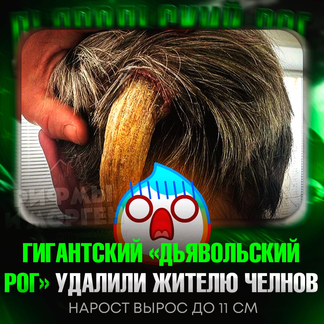 СЛАБОНЕРВНЫМ НЕ СМОТРЕТЬ! У жителя Набережных Челнов на затылке вырос роговидный нарост, напоминающий «дьявольский рог» Мужчина 3 года игнорировал кератому, пока та не стала причиной бессонницы. Оперировавший хирург отметил, что за четверть века практики никогда не видел подобного. Операция полностью устранила проблему. — ЭТО БЛ#ТЬ, ЧТО ЗА Х#ЙНЯ!?!? Рифмы и Морген