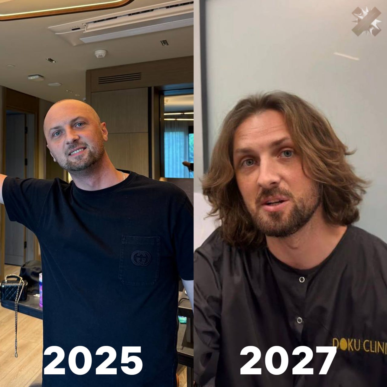 Облысение в прошлом учёные создали сыворотку ускоряющую рост волос на 539 Препарат от Cosmo Pharmaceuticals наносится на кожу головы никаких инъекций Это первый новый продукт против облысения за 30 лет Сейчас чудо сыворотка проходит одобрение в ЕС и США Если всё пойдёт по плану её можно будет купить уже в 2027 году наконец то буду ходить с шевелюрой хм цена будет тоже чудо НМШ