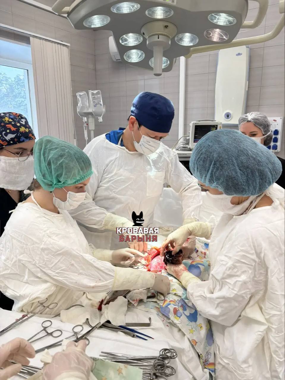 В Калуге девушке на седьмом месяце беременности удалили кисту размером с апельсин 21 летняя пациентка поступила с жалобами на сильные боли живота в Калужский перинатальный центр Кисту округлой формы диаметром 10 см обнаружили позади увеличенной матки она закрывала почти весь обзор брюшной полости Об этом Осторожно Media сообщила пресс служба губернатора и правительства Калужской области Операция осложнялась сроком беременности 27 недель весом плода около 1 кг необходимостью общей анестезии и высоким риском кровотечения Во время вмешательства врачи непрерывно контролировали состояние плода использовали щадящие хирургические методы и следили за жизненно важными показателями матери Кисту удалили полностью беременность сохранилась По завершении операции состояние девушки и ребёнка оценивалось как удовлетворительное