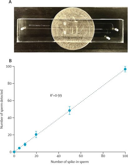 ИИ помог мужчине зачать ребёнка после 19 лет безуспешных попыток Учёные из Колумбийского университета совершили настоящий прорыв нейросистема STAR смогла помочь мужчине с азооспермией редким видом бесплодия при котором в сперме почти нет живых клеток Проблема встречается у 1 мужчин и вызывает до 15 случаев мужского бесплодия 39 летний американец с супругой пытались зачать ребёнка 19 лет и прошли 15 циклов ЭКО но безуспешно ИИ обработал 2 5 млн микроснимков за два часа и нашёл всего семь активных сперматозоидов Два из них использовали для ЭКО и беременность наступила На УЗИ подтвердили нормальное развитие плода роды ожидаются в декабре 2025 года Обычно при азооспермии проводят хирургический поиск клеток под микроскопом процесс занимает дни и часто заканчивается неудачей ИИ справился за часы Учёные надеются что STAR станет новым стандартом диагностики способным вернуть шанс на отцовство тысячам мужчин по всему миру