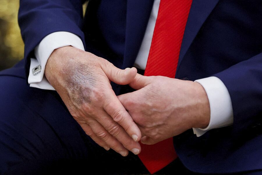 Трамп наконец то рассказал что у него с руками По словам президента США журналистам WSJ он наносит макияж Все из за того что он каждый день принимает большое количество аспирина ради разжижения крови Его дозировка превышает объем рекомендованный врачами в результате чего на его теле легко появляются синяки НМШ