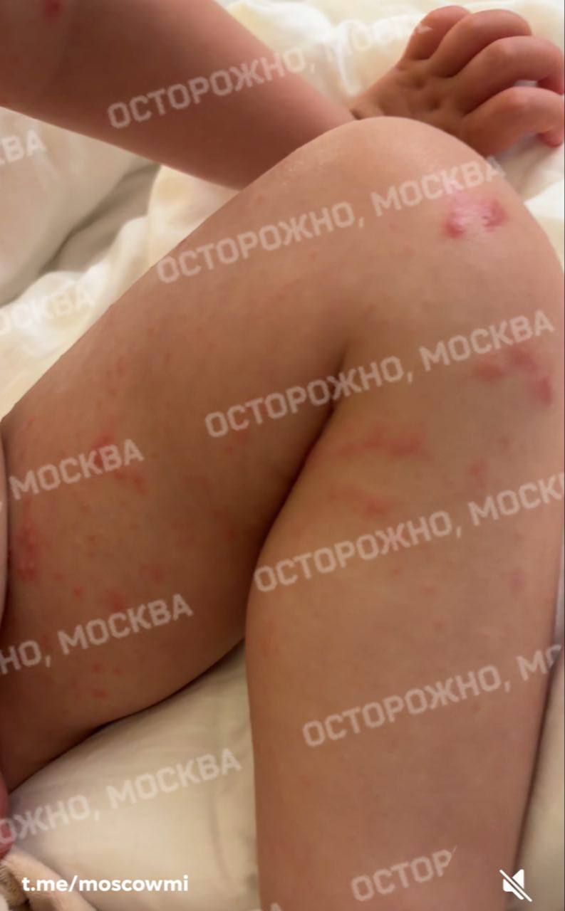 В Турции разгар вируса Коксаки среди российских туристов. Около 15 россиян, в том числе дети, отдыхающие в турецком отеле Starlight resort в Анталье, заразились этим вирусом.