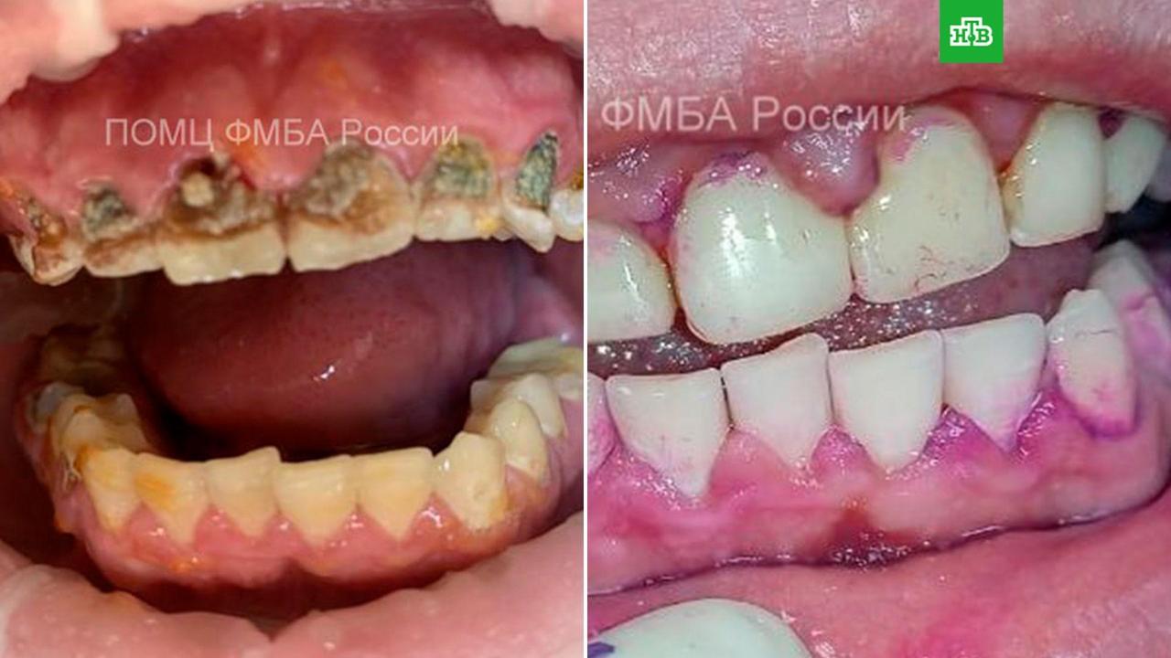 Новая фобия 18 летний парень из Нижнего Новгорода чуть не остался без зубов из за энергетиков Он в течение двух недель непрерывно их пил что привело к разрушению эмали В результате у передних верхних зубов пришлось удалить нервы Стоматологи также восстановили передние зубы пломбами и убрали коричневый налет Как отметили медики высокое содержание сахара в энергетиках повышает кислотность слюны что приводит к разрушению эмали формированию зубных бляшек и кариеса Подписаться на НТВ MAX