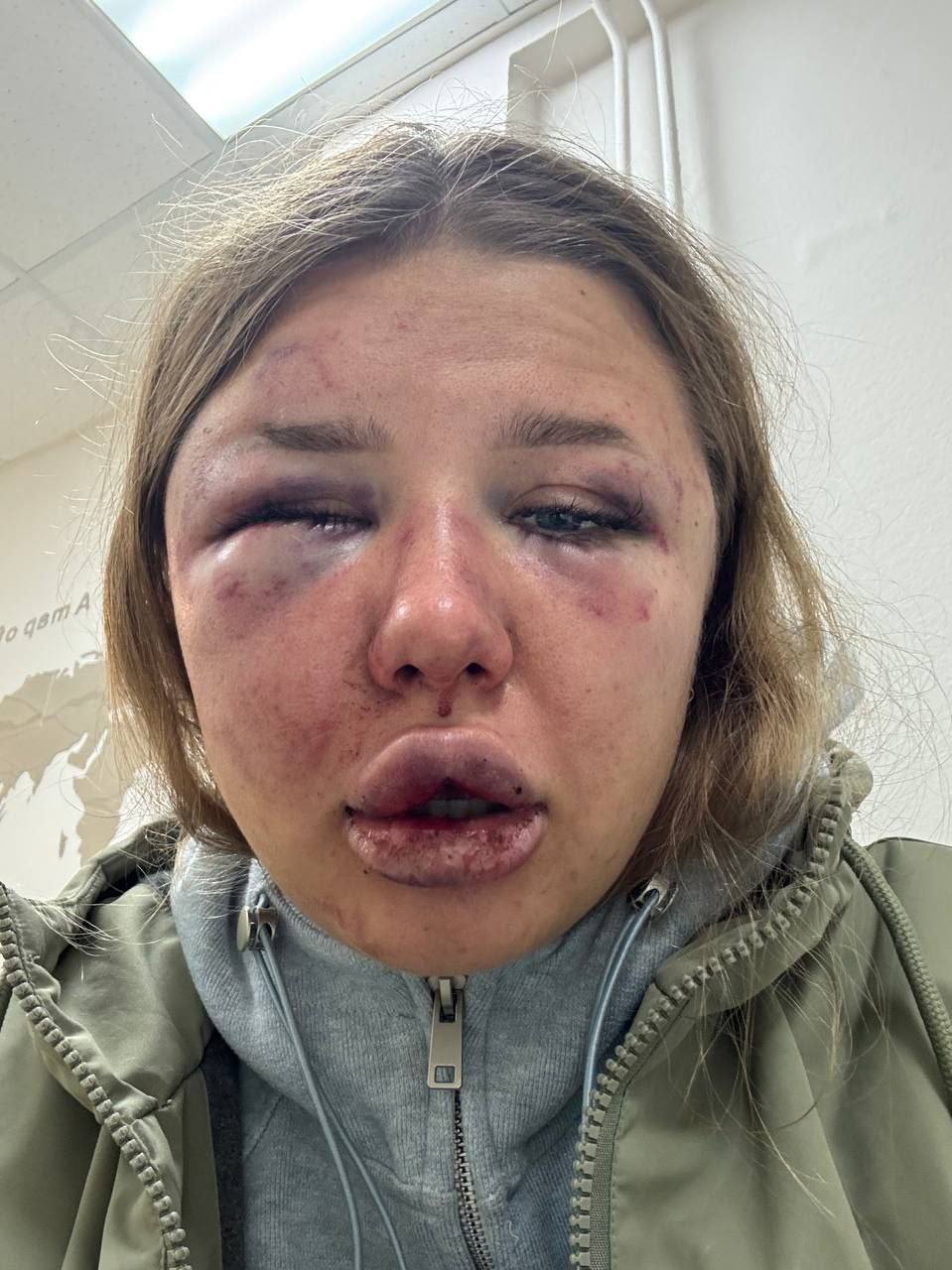 Фото не для слабонервных В Твери боец ММА из Дагестана жестоко избил 20 летнюю девушку 25 летний житель Подмосковья сначала связал девушку у неё в квартире а затем на протяжении четырех часов зверски её избивал У пострадавшей черепно мозговая травма множественные гематомы переломы костей лица Девушке предстоит операция и длительное лечение Оперативники уголовного розыска задержали изверга на территории Московской области Возбуждено уголовное дело Полицейские ходатайствуют перед судом об избрании задержанному меры пресечения в виде заключения под стражу Подпишись на интересные новости