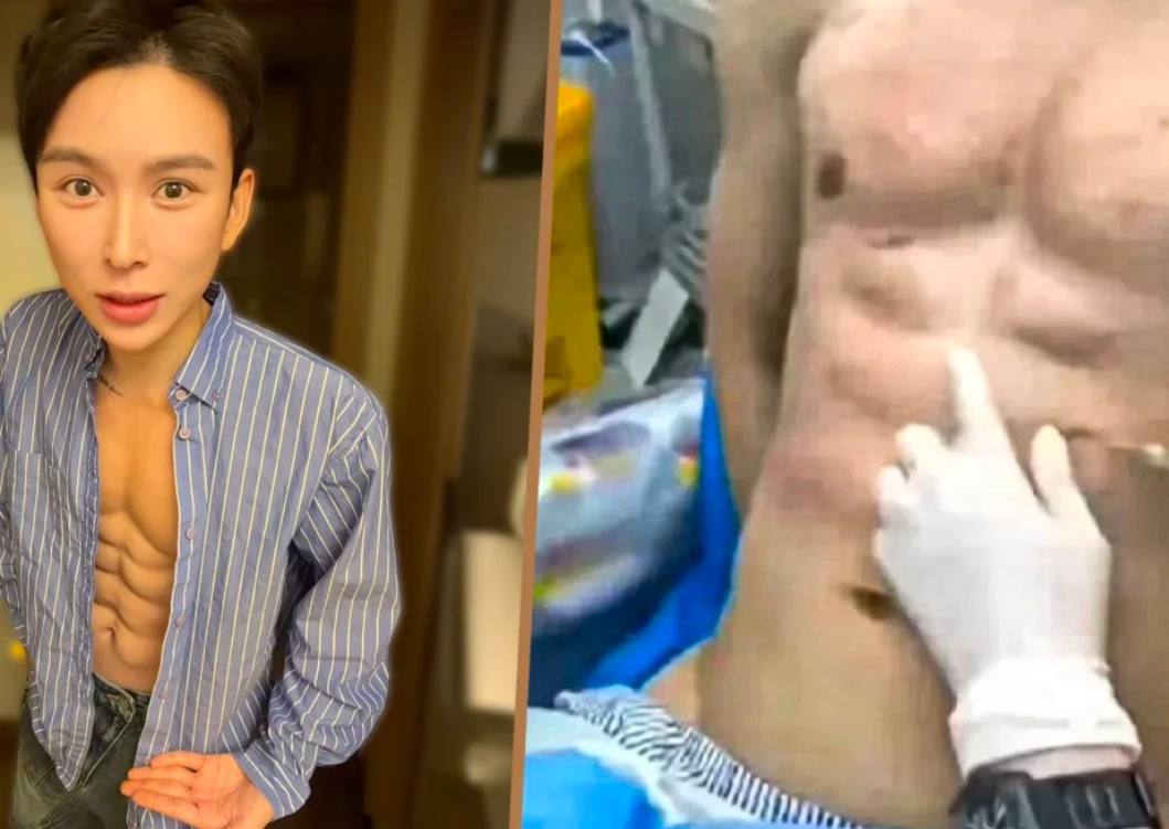 Мужчина потратил 560 тысяч на искусственный пресс из 8 кубиков Энди Хао Тяньнань заплатил порядка 560 тыс 45 млн рублей на инъекции гиалуроновой кислоты чтобы создать себе искусственный пресс из восьми кубиков Мужчина якобы стал первым человеком в Китае с подобным результатом Китаец утверждает что 20 его тела состоит из гиалуроновой кислоты и что он планирует сделать еще 10 тысяч инъекций Сейчас он выполнил порядка 40 от этой цели Если мой пресс сохранится три года я подам заявку в Книгу рекордов Гиннесса на самый долговечный искусственный пресс и даже расколю на нём грецкие орехи в прямом эфире делится планами мужчина По словам блогера он решился на подобные процедуры потому что не смог достичь идеального тела с помощью тренировок Врачи при этом предупреждают что инъекции такого объема могут привести к некрозу кожи смещению филлера и атрофии мышц китай общество мир