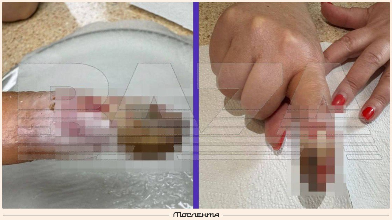 Женщина осталась без пальца после операции в одинцовской клинике Подмосквичка приехала в частную клинику в Одинцово с жалобой на воспалённый палец В больнице хирург начал резать палец с разных сторон Уже тогда ей показалось что что то не так но она доверилась врачу Спустя две недели палец всё ещё болел но теперь почернел Тогда Любовь поехала в клинику им Юдина и там ей поставили диагноз некроз второго пальца правой кисти Женщине сообщили что ей перерезали сухожилия и также неправильно поставили укол из за чего началось отмирание тканей Спасти палец женщине удалось лишь частично ногтя нет а фаланга укорочена На претензию в одинцовской клинике не ответили а лишь обвинили пострадавшую в том что она якобы плохо обрабатывала рану и сама во всём виновата moslentaru