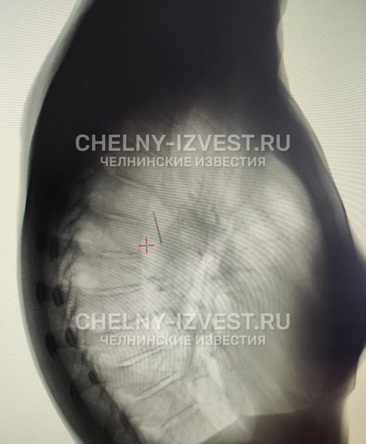 ⏺У челнинки в легком случайно обнаружили швейную иглу  У уроженки Набережных Челнов в ходе прохождения диспансеризации совершенно случайно обнаружили в легком иглу. 40-летняя женщина не жаловалась на здоровье, поэтому давно не ходила на медосмотры.  Диспансеризацию женщина проходила в Москве. В рамках обследования ее отправили на флюорографию – там и выяснилось о неожиданной находке.  На снимке четко увидели инородное тело – обломок иглы размером примерно 3 см. Женщина не знает, как она там оказалась, и не помнит, чтобы глотала ее.  Чтобы извлечь инородное тело, пришлось провести операцию. Сколько лет челнинка носила иглу в легком - неизвестно, но извлеченная игла была ржавой  на снимке для сравнения рядом лежит новая игла . С женщиной все в порядке, она рада, что прошла диспансеризацию, и теперь всех призывает к этому.