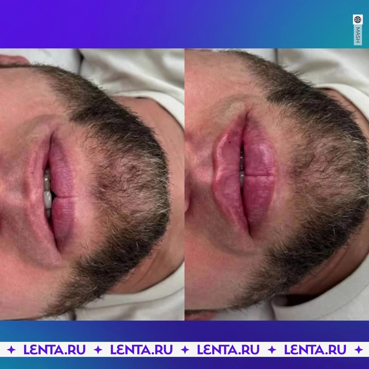 На Кавказе мужчины стали тайно увеличивать губы по ночам. У жителей Дагестана и других республик Северо-Кавказского федерального округа набирает популярность процедура контурной пластики губ среди мужчин. Клиенты платят до 20 тысяч рублей за процедуру, лишь бы об этом никто не узнал. Чаще всего косметологические манипуляции проводят ночью. Косметологам уже поступают угрозы от других мужчин, чтобы они раскрыли имена клиентов. Однако спрос на губки продолжает расти #лентару #косметология #психология