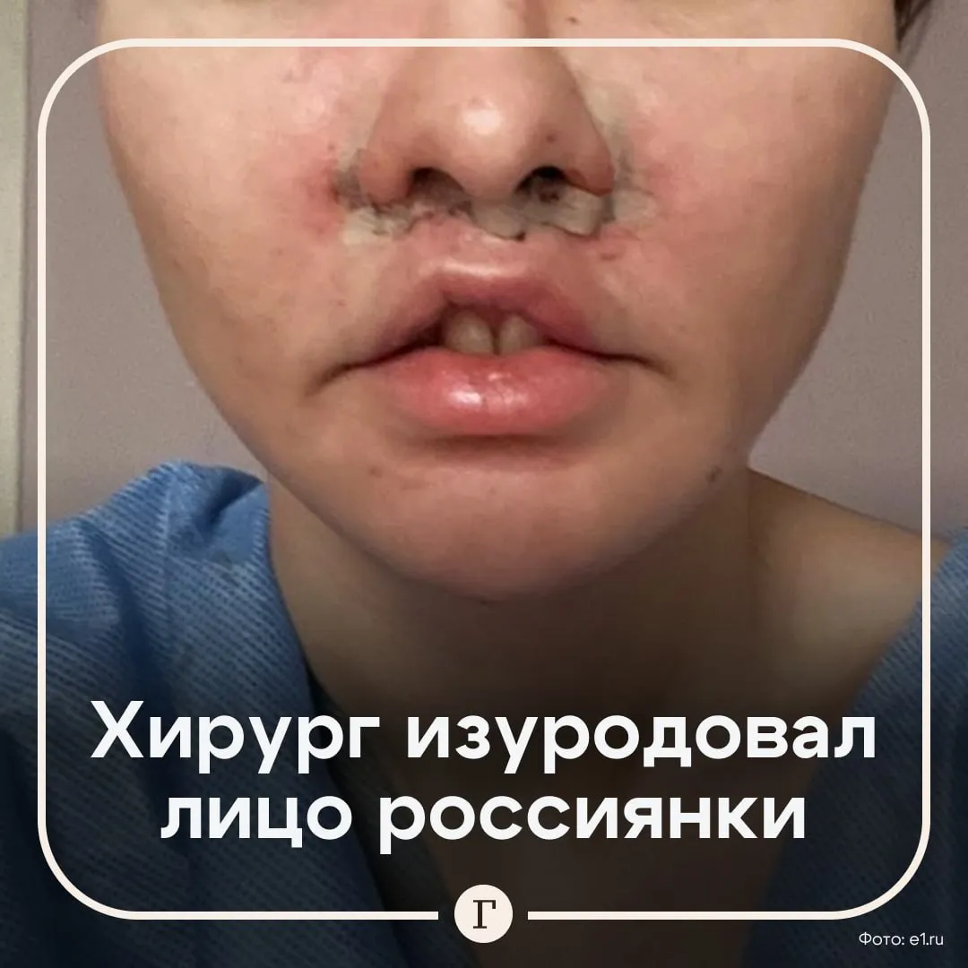 Екатеринбурженка стала жертвой неудачной пластики лишилась семьи работы и дыхания Марина обратилась к известному в городе хирургу Алексею Клепикову за малотравматичным вмешательством чтобы исправить форму верхней губы В день операции врач опоздал на час второпях нарисовал разметку и отправил девушку на операционный стол Когда я проснулась я себя сфотографировала у меня случилась истерика За 30 минут меня превратили в урода Врачи успокаивали меня якобы это просто отек на протяжении трех месяцев Моя жизнь просто превратилась в ад рассказала Марина Был вырезан слишком большой участок кожи губа задралась ноздри стали ассиметричными дикция нарушилась Марина не могла ни есть ни пить ни дышать носом За короткий промежуток времени она лишилась работы любимого мужчины и планов стать матерью в ближайшее время Восстановительные операции пациентка делает в Санкт Петербурге на них уже потрачена четверть миллиона Несмотря на то что клиника свою вину не признает и оправдывает последствия индивидуальными особенностями девушки суд встал на сторону потерпевшей и постановил выплатить ей 1 2 млн руб Читайте Газету Ru в MAX