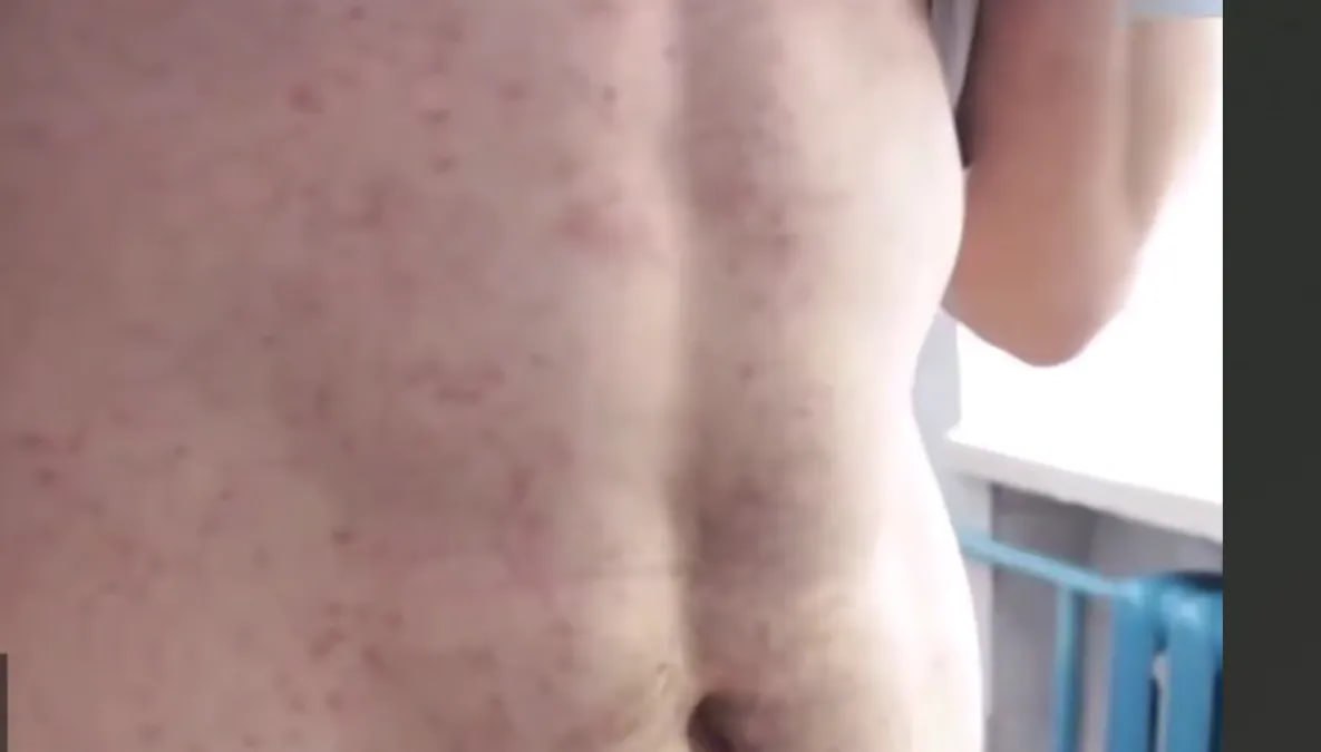 В Хабаровске жители целого подъезда многоэтажки заболели корью Сразу несколько человек заболели корью в одном подъезде многоэтажного дома в Хабаровске Об этом сообщает телекомпания Губерния Как считают специалисты Роспотребнадзора по Хабаровскому краю всему виной отказ от вакцинации Хотя корь есть в национальном календаре обязательных прививок В первые дни корь проявляется как обычная ОРВИ высокая температура насморк сухой кашель боль в горле А уже в разгар болезни по всему телу начинается сыпь причем распространяется она сверху вниз Часто болезнь протекает тяжело корь опасна тем что может привести к летальному исходу так что не стоит пренебрегать обязательными правилами поддаваться современным тенденциям которые отрицают вакцинации В группе риска все возрастные группы от детей до взрослых После выявления очага весь дом отправили на карантин а жителей массово вакцинировали todaykhv