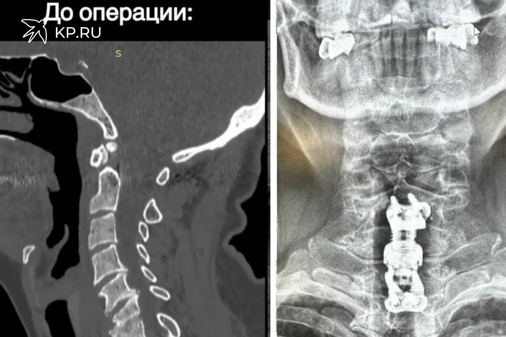 Жительнице Воронежа вживили имплант вместо двух удаленных шейных позвонков Воронежские врачи впервые поставили имплант вместо удаленных шейных позвонков 59 летняя пациентка еще в июле обратилась в БСМП 1 женщину беспокоили боли в шее и повышенная температура У нее выявили воспалительный процесс в межпозвонковом диске и двух позвонках Пациентке провели консервативное лечение купировав болевой синдром и нормализовав температуру Через две недели ее выписали Но спустя два месяца женщина снова обратилась с жалобами на боли в шее а также на онемение и неприятные ощущения в руках При дообследовании врачи выявили патологический перелом тел шестого и седьмого позвонков шейного отдела вследствие спондилодисцита Пациентке провели операцию удалив пораженные позвонки и устранив сдавливание спинного мозга После чего врачи установили телоскопичекий телозамещающий имплант который обеспечил стабильность в данных позвоночно двигательных сегментах После операции у пациентки прошли онемение и боль в руках женщину уже выписали