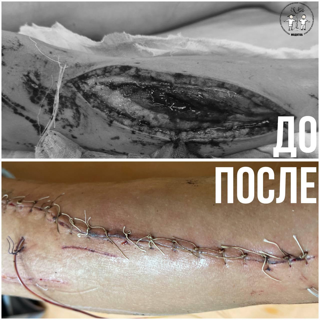 Мангал - это не только шашлыки. Это и адская боль, и разорванная голень, если тебе 13, ты бежишь, не разбирая дороги и не замечаешь стоящую в густой траве конструкцию. Подростка спасли врачи Московской областной детской клинической травматолого-ортопедической больницы. Ожидается, что через три недели он сможет ходить. Фото Минздрава Московской области.