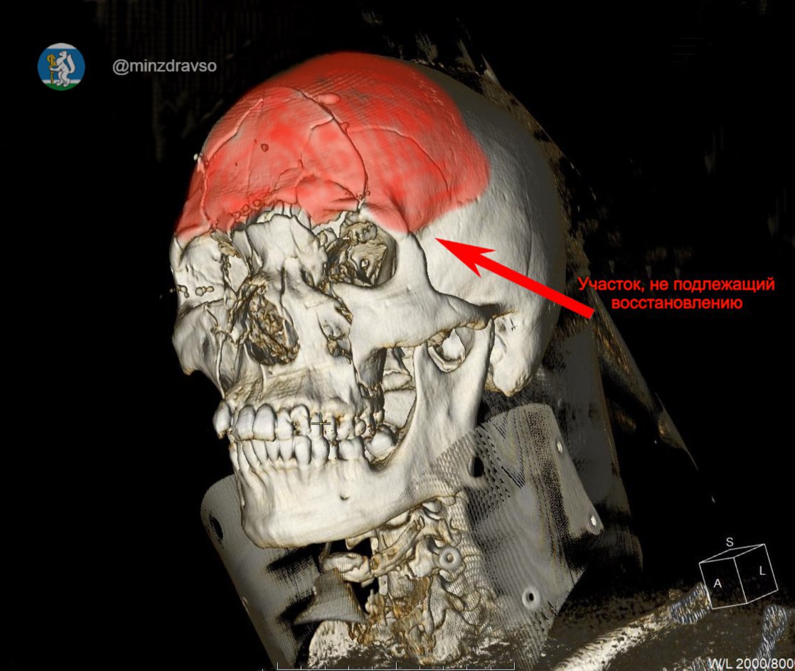 Врачи городской больницы 1 в Нижнем Тагиле вернули к жизни молодого мужчину пострадавшего в жестком ДТП В стационар он попал с раздробленным черепом сложнейшая операция заняла 2 5 часа рассказали в пресс службе медучреждения В ГБ 1 25 летнего парня привезли в тяжелом состоянии с множественными переломами черепа особенно пострадали основание и лобная кость Ситуация осложнялась кровотечением и риском инфицирования головного мозга Всю тяжесть травм нейрохирургам показал высокоточный томограф пациента отправили на экстренную операцию Нейрохирурги провели операцию которая длилась около 2 5 часа Они применили сложную методику бифронтальную трепанацию при которой обеспечивается расширенный доступ к головному мозгу и минимизируются его повреждения остановили кровотечение ювелирно удалили гематомы объёмом около 50 миллилитров провели герметичную пластику мозговой оболочки Оперативное вмешательство позволило избежать тяжёлых неврологических осложнений и спасти жизнь пациента рассказали в первой горбольнице Уральца уже выписали из больницы Но лечение еще не завершено Впереди у мужчины операция по устранению дефекта черепа и реабилитация по индивидуальной программе Фото свердловский Минздрав