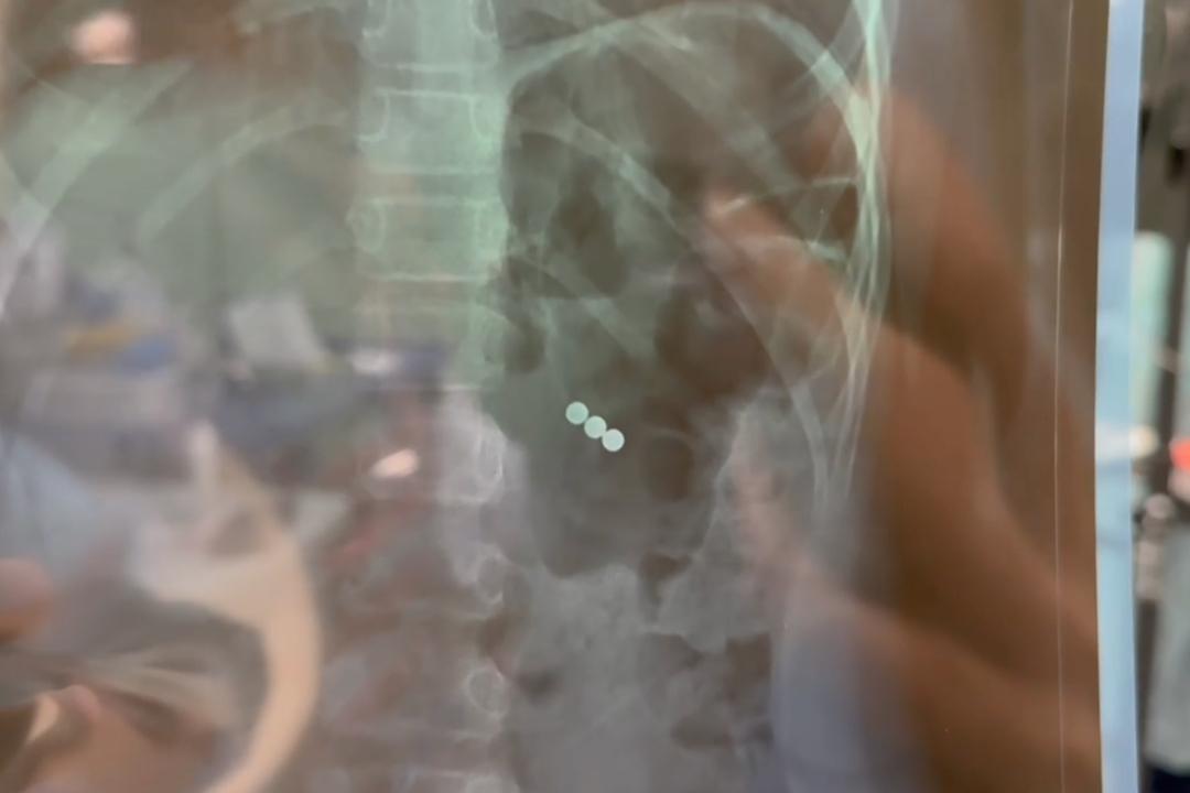 Игра в школе едва не закончилась трагедией В Иркутской области 8 летняя девочка проглотила магниты Безобидные магнитные шарики которые продаются в каждом детском магазине едва не стали причиной настоящей трагедии В Иркутскую областную детскую больницу поступила 8 летняя девочка Во время игры в школе она случайно проглотила три маленьких магнитных шарика Ситуация была крайне опасной Магниты притянулись друг к другу и вызвали перфорации Вместе с командой мы выполнили экстренное малоинвазивное вмешательство и успешно удалили инородные предметы поделился главный врач Иркутской областной детской больницы Юрий Козлов Сейчас девочка идет на поправку но этот случай должен стать серьезным уроком для всех родителей Как отметил Юрий Козлов на сегодняшний день самой большой проблемой являются неодимовые магниты Они существуют разных форм и часто представлены в детских игрушках Если проглатывание одиночного магнита не несет значительной угрозы для здоровья ребенка то проглатывание множественных магнитных инородных тел при притягивании их между собой оказывает силу до полукилограмма поделился главный врач По словам медиков попадание таких сильных магнитов может легко привести к их соединению и вызвать ишемию некроз и другие серьезные заболевания