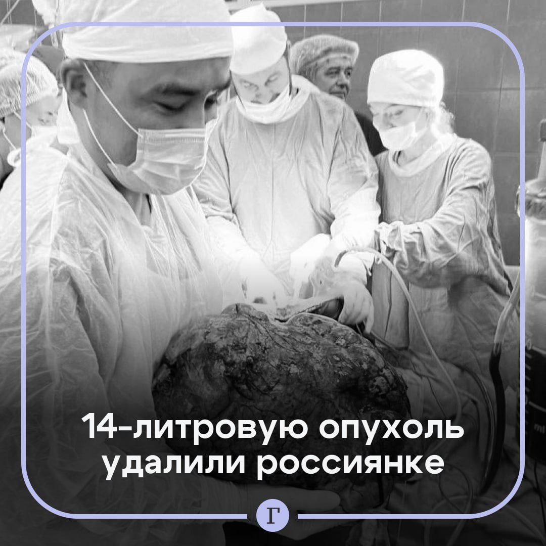 14-литровую опухоль удалили россиянке.  Жительница Подмосковья обратилась в больницу с сильными болями в животе. Она была похожа на истощенную женщину с многоплодной беременностью.  Врачи провели обследование и выяснили, что за два года в брюшной полости пациентки выросло 12-килограммовое образование. В ходе операции медикам удалось извлечь опухоль, в которой находилось 14 литров жидкости.  Сейчас женщина восстанавливается после операции. Был ли пузырь раковым, покажет биопсия.  Подписывайтесь на «Газету.Ru»