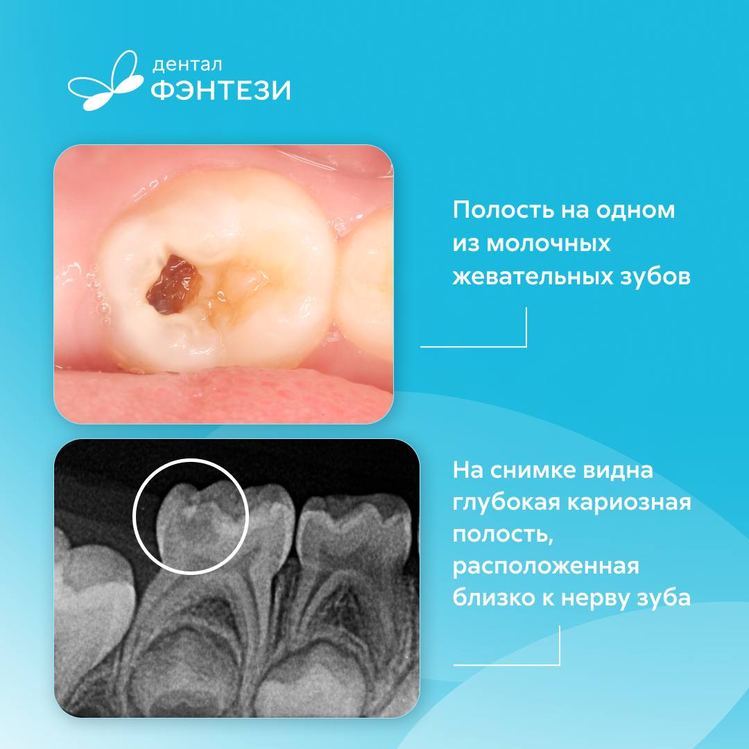 Молочные зубы страдают от кариеса и пульпита так же, как и постоянные. И мы всегда стараемся сохранить их, чтобы у ребенка формировался правильный прикус.  Иногда лучший способ восстановить зуб после лечения пульпита — это установка детских металлических коронок. Об одном из таких случаев рассказала Анастасия Магомедова, детский стоматолог Дентал Фэнтези на ул. Гарибальди, 15.  «Коронованный» зуб для маленькой принцессы  Родители привели на прием 4-летнюю Алису. Девочка не жаловалась на боль, но на одном из ее жевательных зубов появилось подозрительное черное пятно, которое не получалось счистить зубной щеткой.  Доктор провела осмотр и рентгендиагностику и обнаружила, что кариозная полость располагается близко к нерву. Во время лечения стало понятно, что нерв воспален частично, поэтому можно убрать только его пораженную часть.  Удалось избежать лечения каналов и спасти зуб. Теперь нужно было установить на него пломбу или коронку, чтобы восстановить жевательную функцию и защитить зуб от повторного появления кариеса.  Совместно с родителями было принято решение восстановить зуб с помощью коронки: жевательный зуб испытывает большую нагрузку, но должен прослужить Алисе еще более 5-ти лет — до смены на постоянный.  Доктор установила детскую металлическую коронку, и Алиса была в восторге: теперь у нее есть зуб, как у настоящей принцессы!