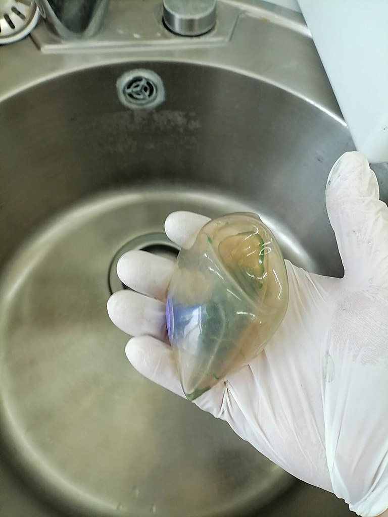 Гастробаллон вызвал опасное осложнение В Находке врачи спасли жизнь 35 летней женщине у которой гастробаллон для снижения аппетита вызвал серьёзное осложнение Устройство привело к прободной язве желудка из за чего его содержимое начало вытекать в брюшную полость вызывая опасное воспаление Женщина три дня терпела боль прежде чем обратиться к врачам Хирурги провели экстренную лапароскопическую операцию устранив дефект в желудке и обработав внутренние органы Баллон извлекли через пищевод с помощью эндоскопа Операция прошла успешно и через неделю пациентку выписали из стационара Сейчас она продолжает лечение под наблюдением специалистов поликлиники Источник Находкинская городская больница dvved