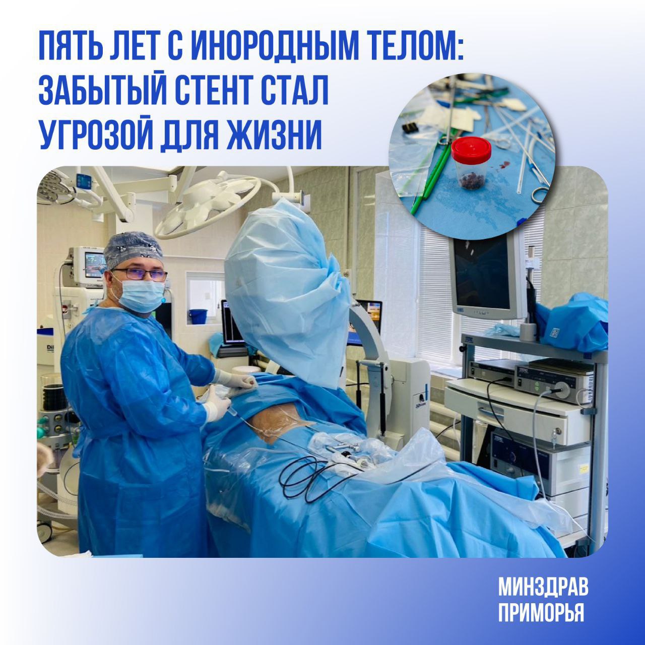 Огромный коралловидный камень из почки пациента удалили врачи Владивостокской клинической больницы №2 Медики провели успешную операцию, удалив образование вокруг старого мочеточникового стента, установленного в 2019 году. Из-за длительного пренебрежения рекомендациями медиков камень разросся настолько, что занял почти всю почечную полость. Несмотря на сложность операции, длиною свыше пяти часов, врачам удалось сохранить пациенту почку. Руководивший операцией заведующий урологическим отделением Николай Вечерка акцентировал внимание на важности строгого соблюдения сроков удаления временных медицинских устройств. #ДФО #Владивосток #медики #операция