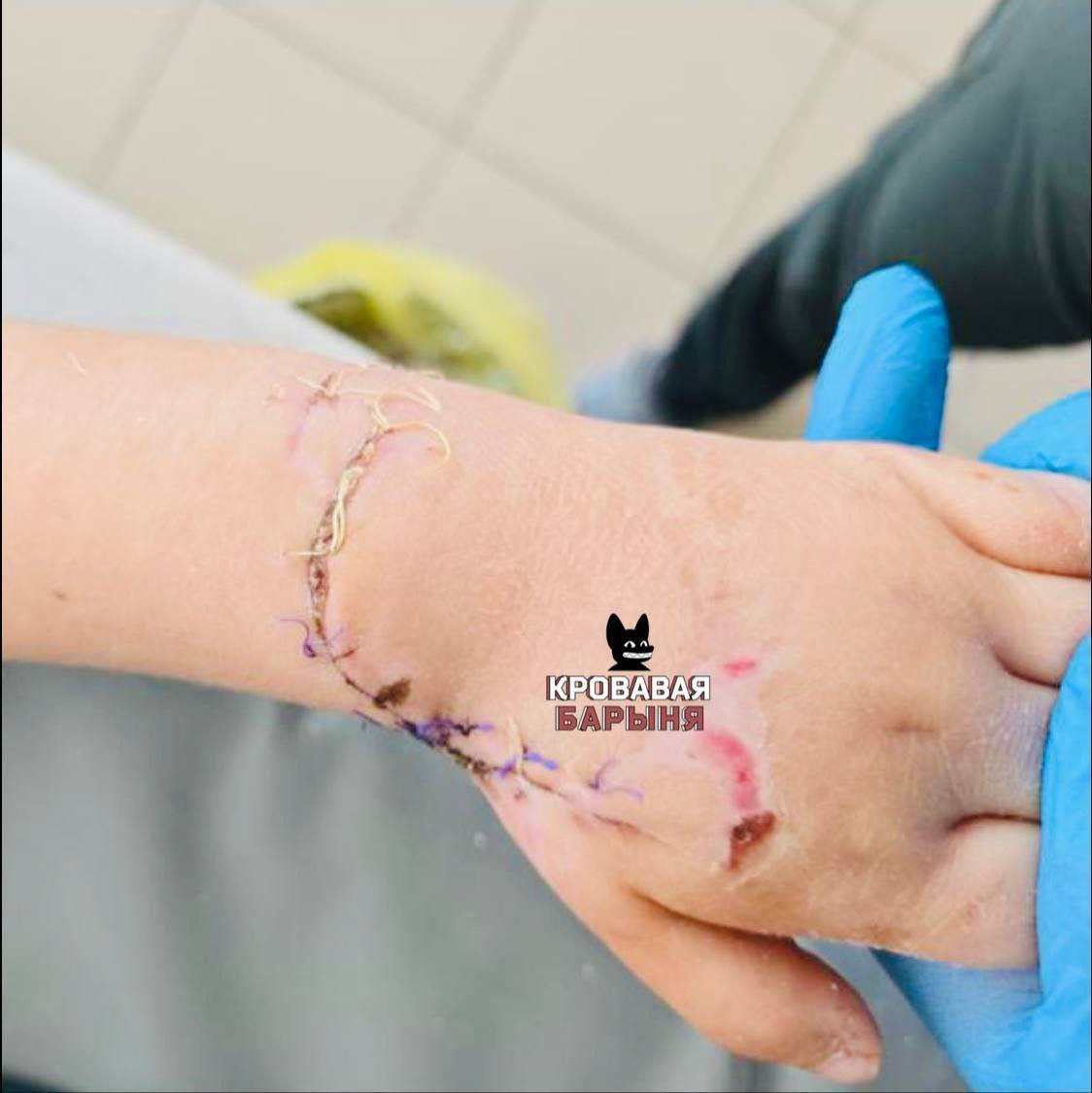 Спасли руку ребёнка В Приморье врачи совершили настоящее чудо вернув маленькой девочке возможность двигать рукой после страшного несчастного случая Напомним в конце ноября в ТЦ Фокино четырёхлетняя малышка упала на эскалаторе и её руку частично затянуло под полотно механизма Ситуация была критической но благодаря профессионализму медиков ребёнка удалось спасти Первую помощь девочке оказали в Находкинской городской больнице а затем её перевели в детское ортопедо травматологическое отделение ВКБ 2 во Владивостоке Диагноз звучал пугающе синдром длительного сдавления кисти открытый перелом со смещением рвано ушибленные раны с повреждением артерии нерва и мягких тканей Ситуацию осложняли участки некроза угрожавшие ампутацией Под руководством заведующей отделением Евгении Кудиновой команда медиков провела серию сложнейших операций Ежедневные перевязки хирургические обработки реконструктивные вмешательства и пластика раны стали частью долгого пути к восстановлению Спустя месяц у девочки начали восстанавливаться движения в пальцах В конце декабря ребёнка выписали домой Основной этап лечения завершён но впереди ещё длительная реабилитация Фото Кровавая барыня Подписаться на Telegram  Подписаться в MAX