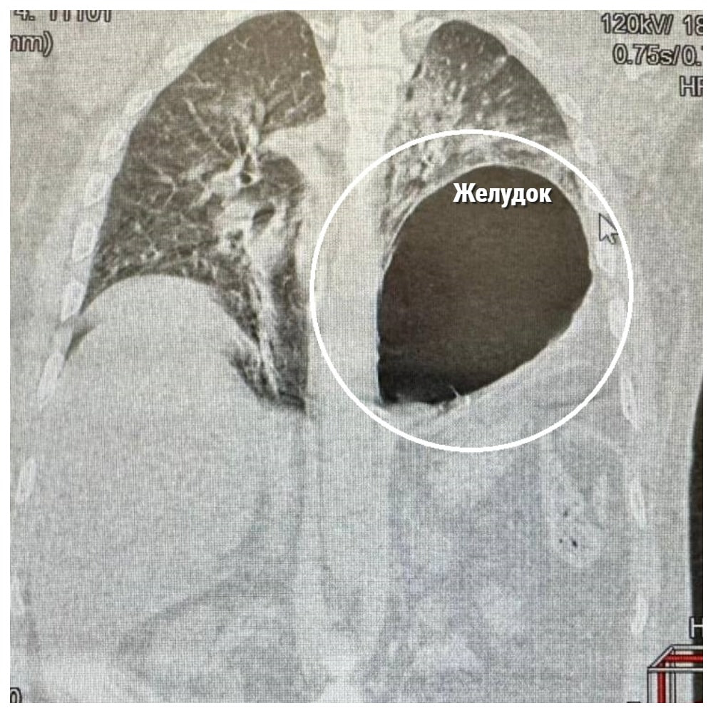 Желудок сместил легкое у жителя Подмосковья после сильной травмы, от которой он едва не умер.  45-летний пациент поступил в Истринскую больницу после падения с высоты – мужчина не мог двигаться и с трудом дышал. Врачи диагностировали закрытую травму груди и живота, перелом 5 ребер, и другие тяжелые последствия. Специалисты понимали, что счет идет на минуты: в ходе операции органы вернули на положенные места, зашили диафрагму, через некоторое время пациент поправился и был выписан.    «Москва»