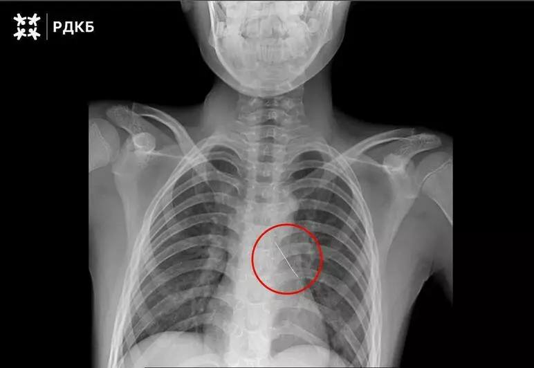 В Москве хирурги спасли ребёнка из Калининграда который вдохнул булавку Изогнутая французская булавка пронзила бронх что могло привести к серьезным нарушениям дыхания и даже коллапсу легкого 11 летнего пациента доставили в столицу бортом санавиации Мальчик мог только шептать и испытывал сильные боли Хирурги извлекли инородное тело с помощью оптических щипцов Кровотечение купировалось самостоятельно Через три дня после успешной операции ребёнка выписали Фото тг канал Российской детской клинической больницы