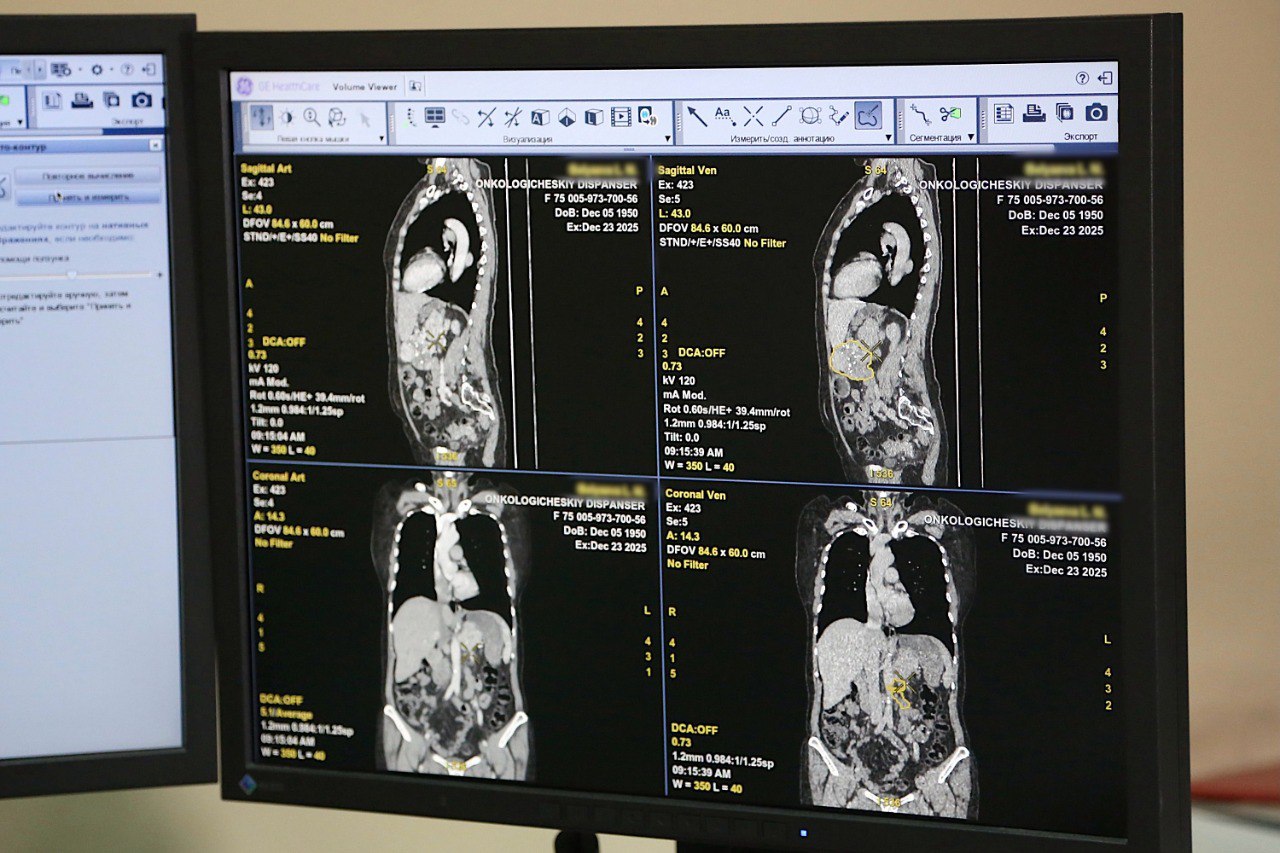 В новгородском онкодиспансере заработал новый компьютерный томограф экспертного класса Система рентгеновской компьютерной томографии всего тела приобретена по государственной программе Развитие здравоохранения Новгородской области Ежегодно в онкодиспансере выполняется около 10 тысяч компьютерно томографических исследований Благодаря усовершенствованным алгоритмам съемки и обработки изображений новая установка обеспечивает высокое качество диагностики при сниженной лучевой нагрузке на пациента Кроме того для исследований требуется меньший объем контрастного вещества что минимизирует риски возможных осложнений Новое оборудование имеет набор специальных программ для объективной оценки опухолевых процессов на фоне проводимого лечения Аппарат рассчитан на пациентов до 160 килограммов Томограф впервые позволяет внедрить виртуальную колоноскопию альтернативный колоноскопии метод выявления мелких полипов кишечника в том числе для пациентов с аномалиями развития кишечника Прибор подключен к единой региональной радиологической информационной системе Результат исследования сможет увидеть врач который будет работать с пациентом за пределами онкологического диспансера в другом учреждении области