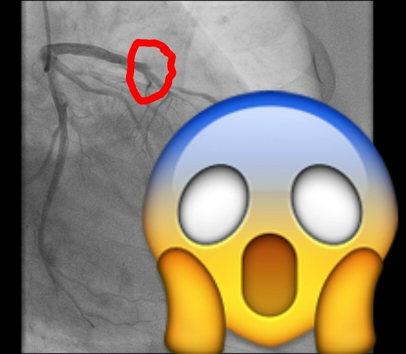 Балаковец чуть не умер по время уборки снега В больницу поступил 59 летний мужчина после того как почувствовал острую боль в груди во время уборки снега Бригада скорой помощи диагностировала острый инфаркт миокарда В больнице в ходе обследования у пациента выявили острую тромботическую окклюзию передней межжелудочковой артерии то есть закупорку сосуда который неофициально называют артерией вдов из за высокой летальности при его поражении Операционной бригадой было выполнено экстренное стентирование артерии в результате чего ее проходимость была полностью восстановлена Кардиологи напоминают не перегружайте сердце на морозе Холод в сочетании с интенсивной физической активностью создают критическую нагрузку на сердечно сосудистую систему Фото Балаковская городская клиническая больница Мы в MAX Мы в TG Прислать новость