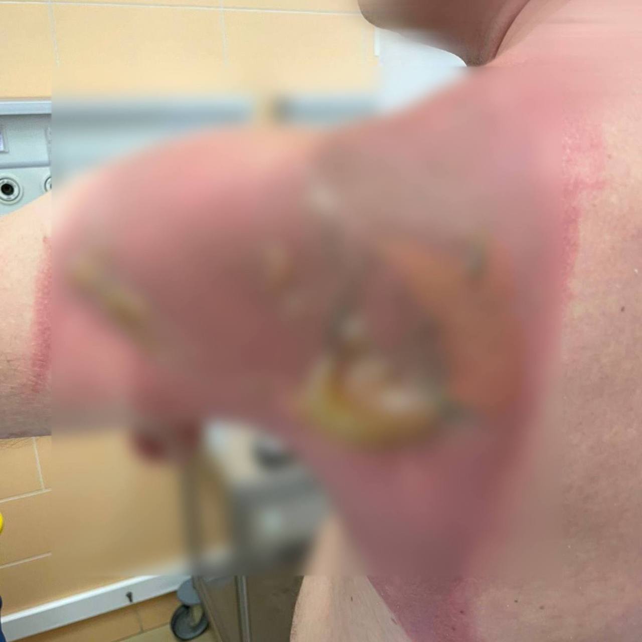 Казанец получил сильнейший химический ожог после стирки белья капсулами из Азии РКБ Мужчина рассказал что супруга постирала постельное белье с новым средством из Азии а утром он проснулся уже с ожогом kazan