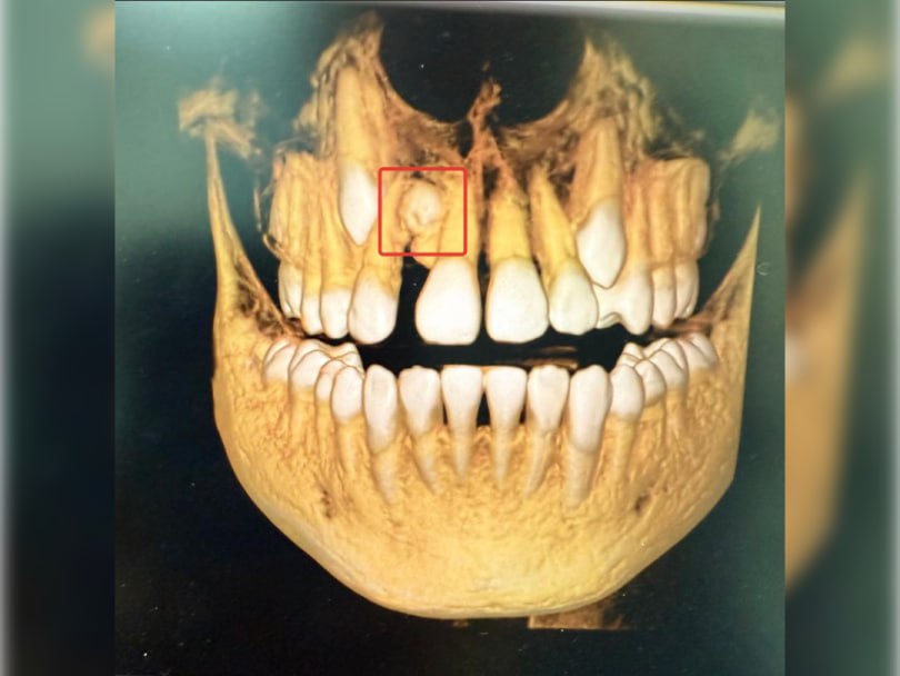 В Уфе стоматологи удалили подростку лишний зуб  В башкирской столице в детской стоматологической поликлинике №7 врачи удалили 13-летнему подростку лишний зуб. По статистике, эта аномалия встречается крайне редко - 1 случай на 1000.  Как сообщили в пресс-службе Минздрава РБ, школьник обратился в стоматологическую поликлинику с жалобами на эстетические проблемы. При проведении компьютерной томографии врачи обнаружили лишний зуб на верхней челюсти.  Данная аномалия может вызвать ряд проблем, так как неправильное расположение зубов влияет на речь, форму лица и смыкание челюсти. Кроме того, сверхкомплектные зубы затрудняют гигиену полости рта, что может привести к заболеваниям десен и кариесу.  В результате врачи удалили лишний зуб и провели ортодонтическое лечение.