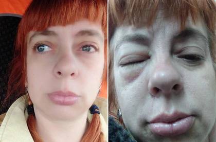 Дончанка ослепла на один глаз из за соринки и стала помогать другим больным людям Весной 2021 года во время ветра Светлане Авдеевой матери пятерых детей в глаз попала соринка Местный офтальмолог с большим стажем назначила только капли не проведя необходимого анализа Лечение не помогло развился кератит а затем язва роговицы Состояние женщины резко ухудшилось появилось бельмо мучительные боли возникла угроза удаления глаза После долгой реабилитации правый глаз полностью ослеп а на левом зрение резко ухудшилось Светлане оформили инвалидность по зрению Специалисты в Москве сообщили что случай безнадежен и она со временем ослепнет и на второй глаз Но Светлана решила добиться справедливости было возбуждено уголовное дело против врача по статье о причинении тяжкого вреда здоровью по неосторожности Несмотря на трагедию женщина нашла в себе силы помогать другим консультирует людей помогает им отстаивать свои права в медицине и бороться с некачественными услугами Подпишись на КП Ростов
