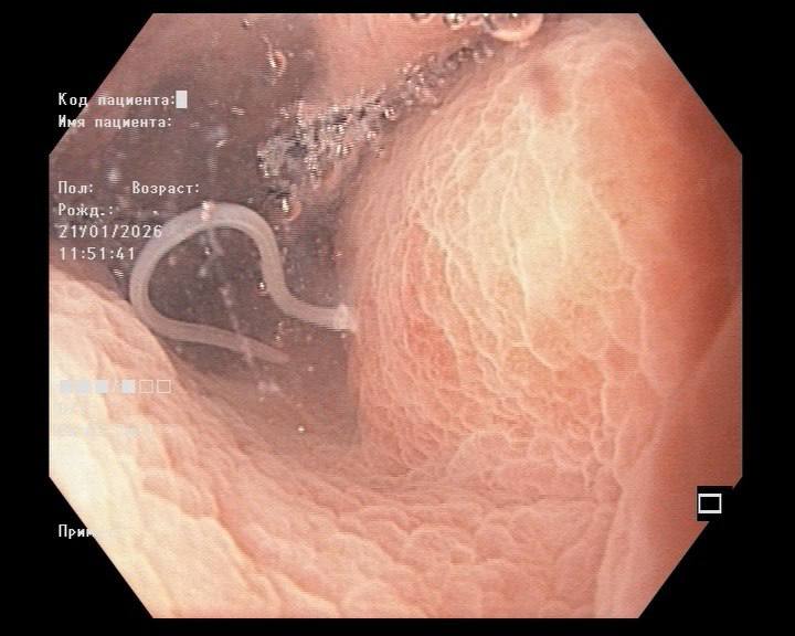 Червяков длиной в 4 см обнаружили у пенсионерки врачи Приморья 70 летняя жительница Владивостока обратилась за медицинской помощью с сильными болями в животе Терапевт направил пациентку на гастроскопию в Приморскую краевую клиническую больницу 1 Во время обследования врачи выявили анизакидоз острое паразитарное заболевание связанное с употреблением рыбы без достаточной термической обработки Как выяснилось накануне женщина съела слабосолёную сельдь купленную у частных продавцов Об этом в разговоре с Осторожно Media сообщил минздрав Приморского края К стенке желудка пациентки присосались два паразита длиной около 4 см Их удалили эндоскопически с помощью специальных щипцов После процедуры состояние пациентки улучшилось госпитализация не потребовалась Как уточнила главный эндоскопист Приморья Екатерина Кочергина подобное заражение может привести к серьёзным осложнениям включая перфорацию кишечника и перитонит Врачи напоминают что личинки гельминтов не погибают при обычной засолке Безопасность обеспечивают только промышленная заморозка и полноценная термическая обработка рыбы