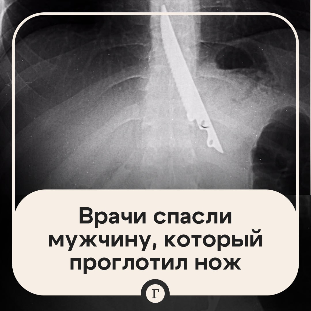 Врачи вытащили нож из желудка москвича.  Мужчина отдыхал с друзьями и жарил шашлык на природе. Во время обеда он неудачно съел кусочек мяса и подавился.   Его товарищи не придумали ничего лучше, как протолкнуть застрявший шашлык ножом. В итоге мужчина случайно проглотил и острый предмет.   Москвича экстренно доставили в НИИ им. Склифосовского, к счастью, врачам удалось достать нож и спасти жизнь мужчине.     — С такими друзьями и врагов не надо