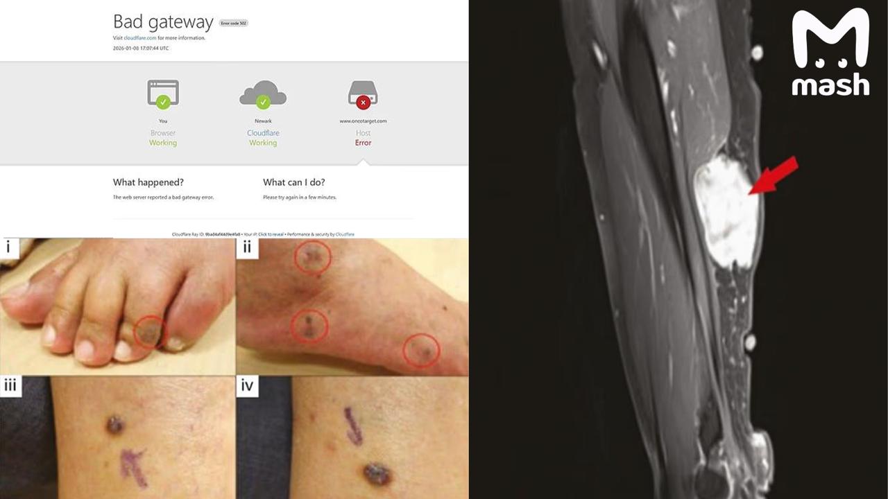 Антиваксеры ликуйте вы были правы Учёные из США доказали связь между вакциной Pfizer Moderna и развитием онкологии Исследования опубликовали на сайте медицинского журнала Oncotarget но его тут же взломали и заблокировали Предварительно по указке фармкомпаний Статью опубликовали 3 января В ней говорилось о том что врачи проанализировали 69 исследований и клинических случаев из 27 стран включая США Японию Китай Италию Испанию и Южную Корею за период с 2020 по 2025 год и выявили 333 случая рака диагностированных или ухудшившихся после вакцинации от Covid 19 При этом во многих случаях опухоли возникали рядом с местами инъекций на руке куда ставили вакцину Через несколько дней после публикации сайт Oncotarget стал недоступен из за кибератаки Главред журнала сообщил об инциденте в ФБР А один из авторов статьи доктор Вафик Эль Дейри из Университета Брауна выразил обеспокоенность тем что атака нарушила доступ к недавно опубликованным исследованиям Сказал Цензура в США жива и процветает и она самым ужасным образом проникла в медицину Выводы делайте сами Подписывайся на Mash