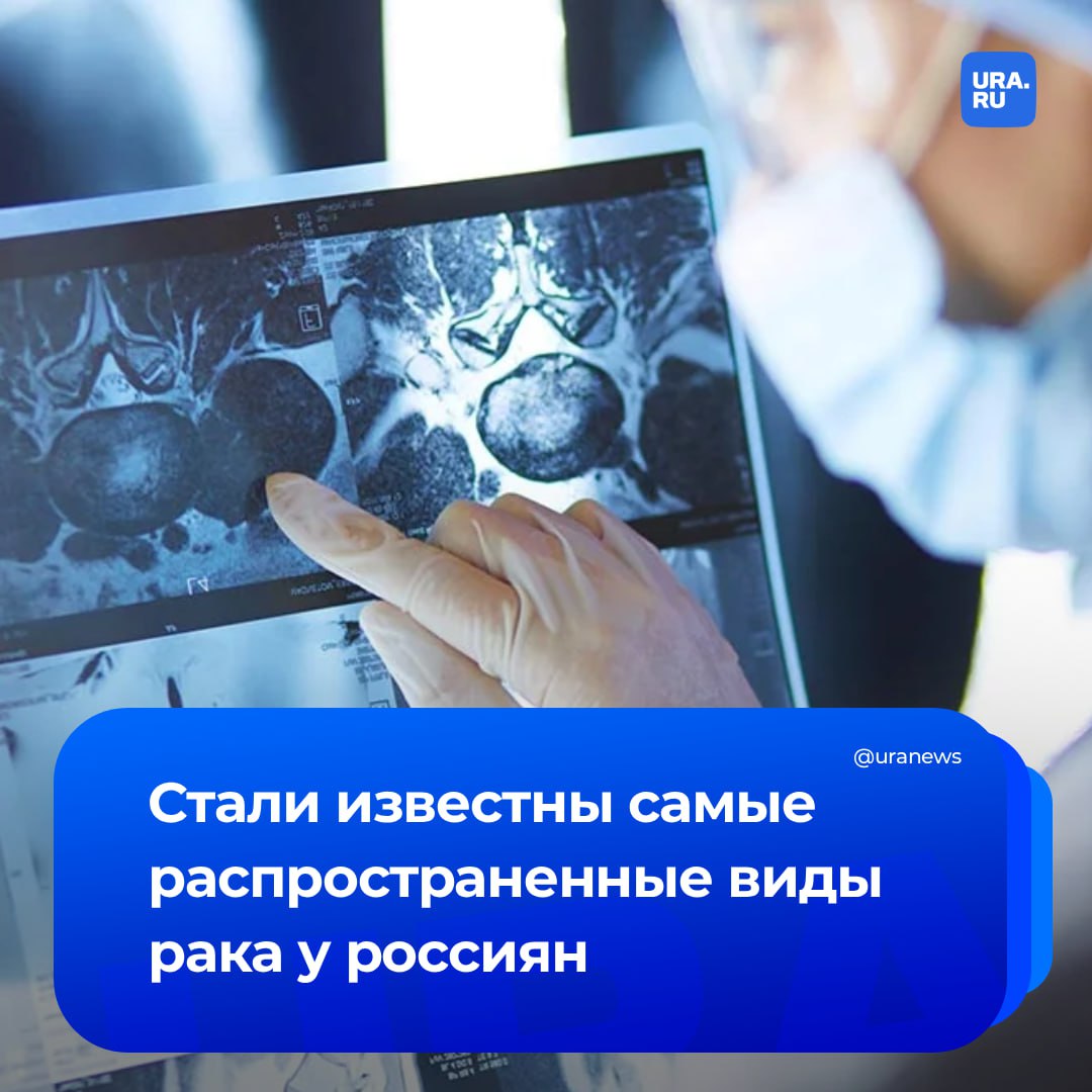 Какие виды рака наиболее распространены в России На этот вопрос на площадке международного форума онкологов ответил главный внештатный специалист Минздрава Андрей Каприн По его словам у мужчин чаще всего встречается рак предстательной железы Не менее распространены заболевания бронхов трахеи легких У женщин в большинстве случаев выявляется рак молочной железы и тела матки передает ТАСС слова Каприна Смертность от недуга занимает второе место как в России так и в мире Однако ранняя диагностика значительно повышает шансы на выздоровление И в нашей стране 64 онкологических заболеваний выявляются на первых этапах развития Подписаться на URA RU мы в MAX