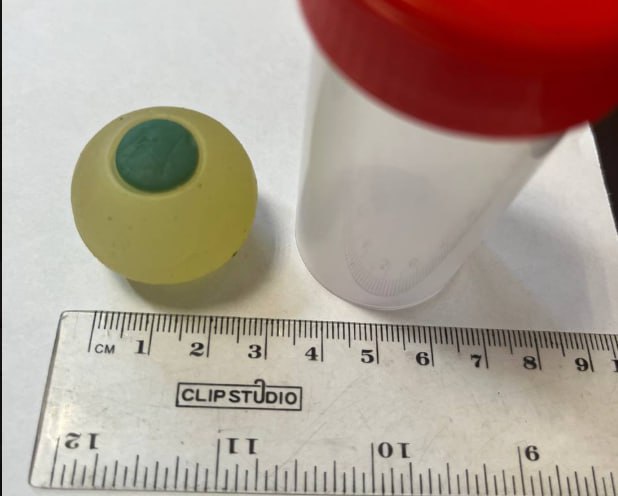 В Челябинске из кишечника ребёнка извлекли силиконовый глаз Из инфекционного отделения другой городской больницы был переведён юный пациент Первоначально у ребёнка наблюдались симптомы характерные для отравления или инфекции тошнота рвота и боли в животе Однако поставленный диагноз не нашёл подтверждения Врачи долго не могли понять что случилось потому что ребёнок как ни спрашивали не вспоминал что проглотил игрушку ПОДРОБНЕЕ URALPRESS RU