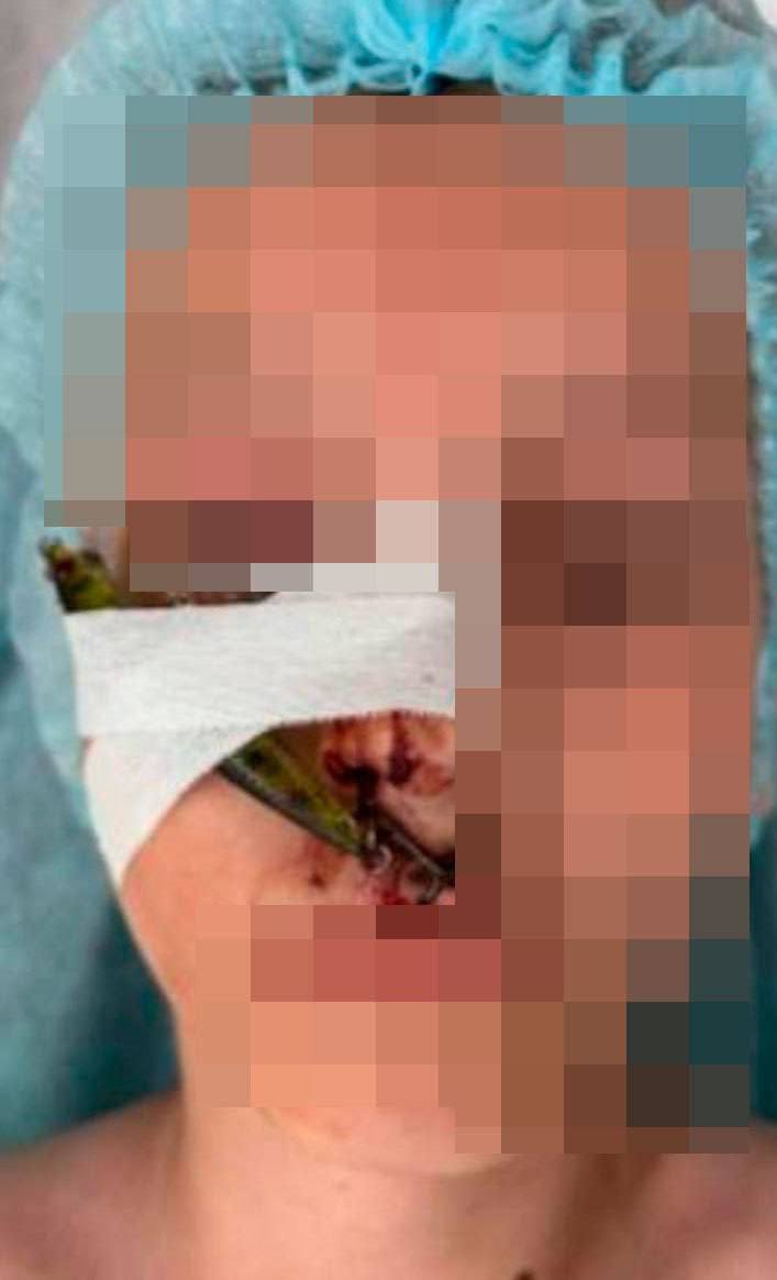 Рыбалка оказалась опасна для здоровья! В Подмосковье 10-летний мальчик не справился с удочкой и зацепил сам себя за лицо  Воблер впился в лицо ребенка. Маленького рыбака увезли в Детский клинический центр Рошаля. Там врачи аккуратно удалили крючок и зашили раны. Зрение ребенка не пострадало.  Подписаться