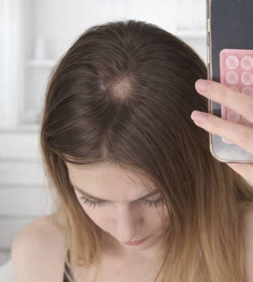 Москвичка примерила шапку с маркетплейса и начала терять волосы Врач сообщил ей что причиной может быть микоз грибковая инфекция или очаговая алопеция процесс когда волосы выпадают на некоторых участках тела Девушка связала облысение с примеркой шапки накануне 1 новая фобия