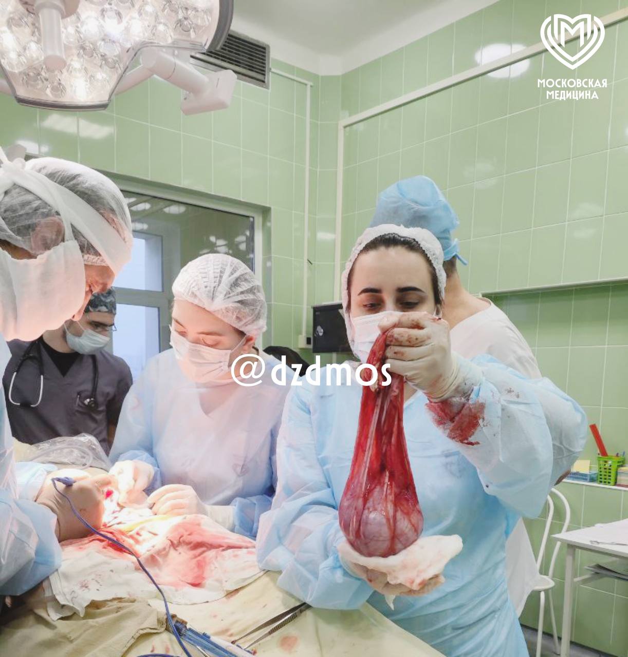 Столичные хирурги удалили у 15 летней пациентки кисту размером с живот Гигантское новообразование правого яичника нашли во время диспансеризации Полость объёмом 7 литров занимала практически весь живот После того как онколог исключил рак школьницу прооперировали в Детской больнице Сперанского рассказали в столичном Депздраве Врачи установили дренаж чтобы слить жидкость из кисты а потом через небольшой разрез в паховой области цистаденому полностью извлекли Растянутую кистой ткань яичника удалили и сделали пластику чтобы девушка в будущем могла стать мамой Сейчас пациентку выписали домой Ей предстоит наблюдаться у гинеколога онколога чтобы избежать рецидива Московская медицина Подписаться на Москва 24 Наши каналы Новости в MAX