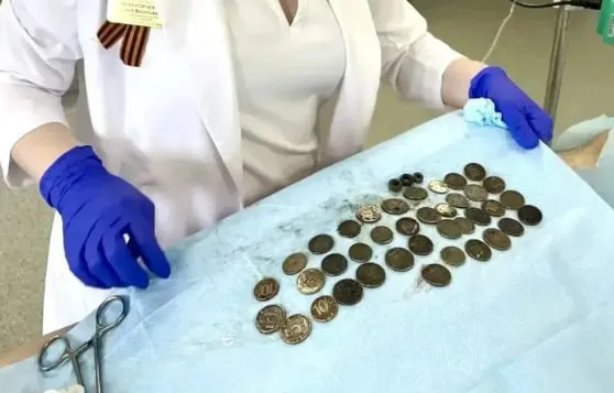 Хирурги достали из волгоградца сотни монет и дверные петли Медики извлекли из желудка и пищевода 50 летнего мужчины 227 предметов пациент поступил в больницу 25 с предположением о наличии кровотечения в ЖКТ Проведя обследование врачи ахнули К счастью ситуация позволяла прибегнуть к малоинвазивной эндоскопической методике которая не требует разрезов Во время нее из мужчины достали 214 железных монет 11 гаек и пару дверных петель Как они оказались у него в желудке история умалчивает Мы в Макс
