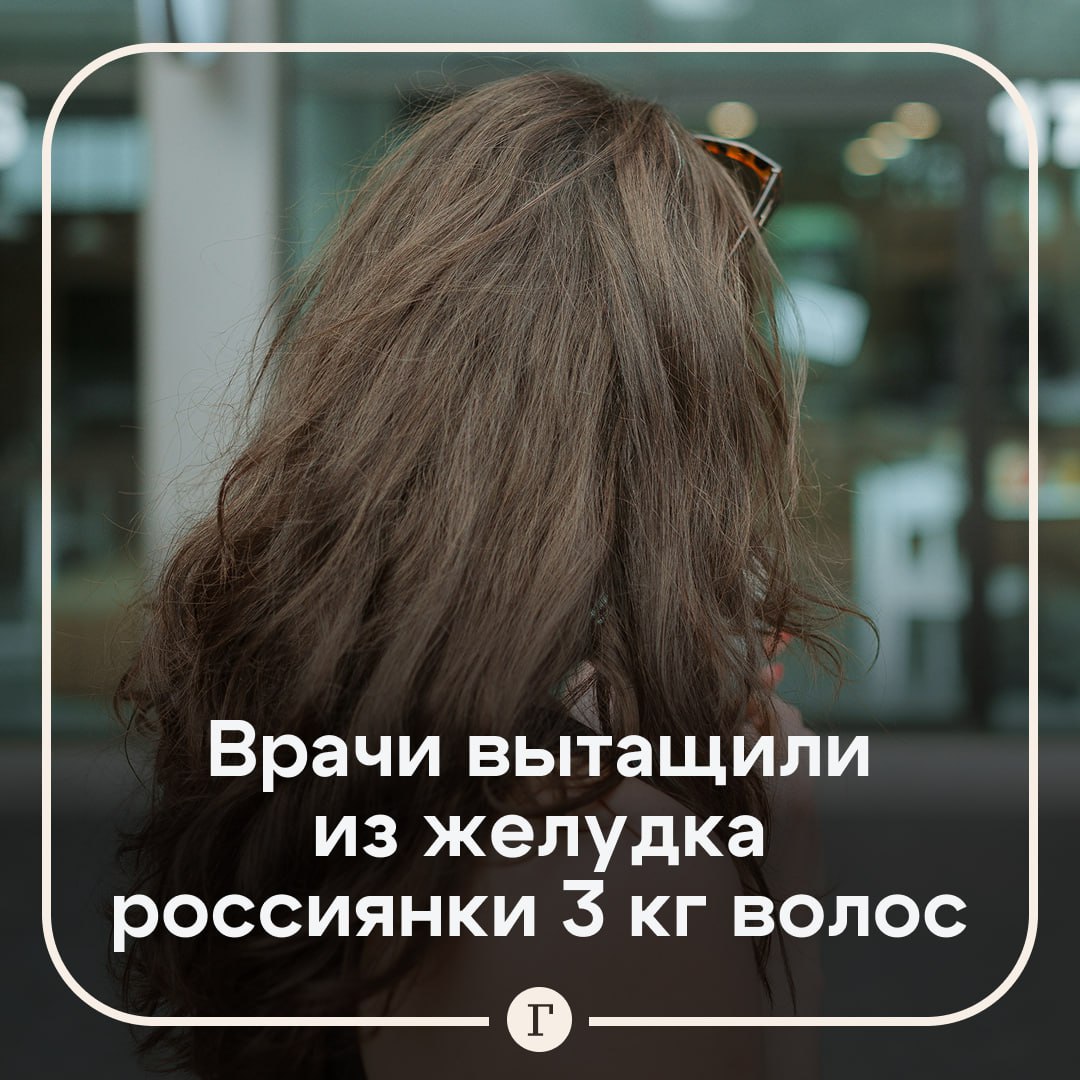 Трехкилограммовый ком волос вытащили из желудка россиянки. Во время обследования врачи обнаружили в ЖКТ 17-летней девушки инородное тело внушительных размеров. Было принято решение о проведении хирургического вмешательства. Во время операции выяснилось, что это был комок волос весом 3 кг. Вероятно, он возник из-за так называемого «синдрома Рапунцель» — навязчивого желания жевать и глотать волосы. После успешного извлечения трихобезоара девушка пошла на поправку. Подписывайтесь на «Газету.Ru»